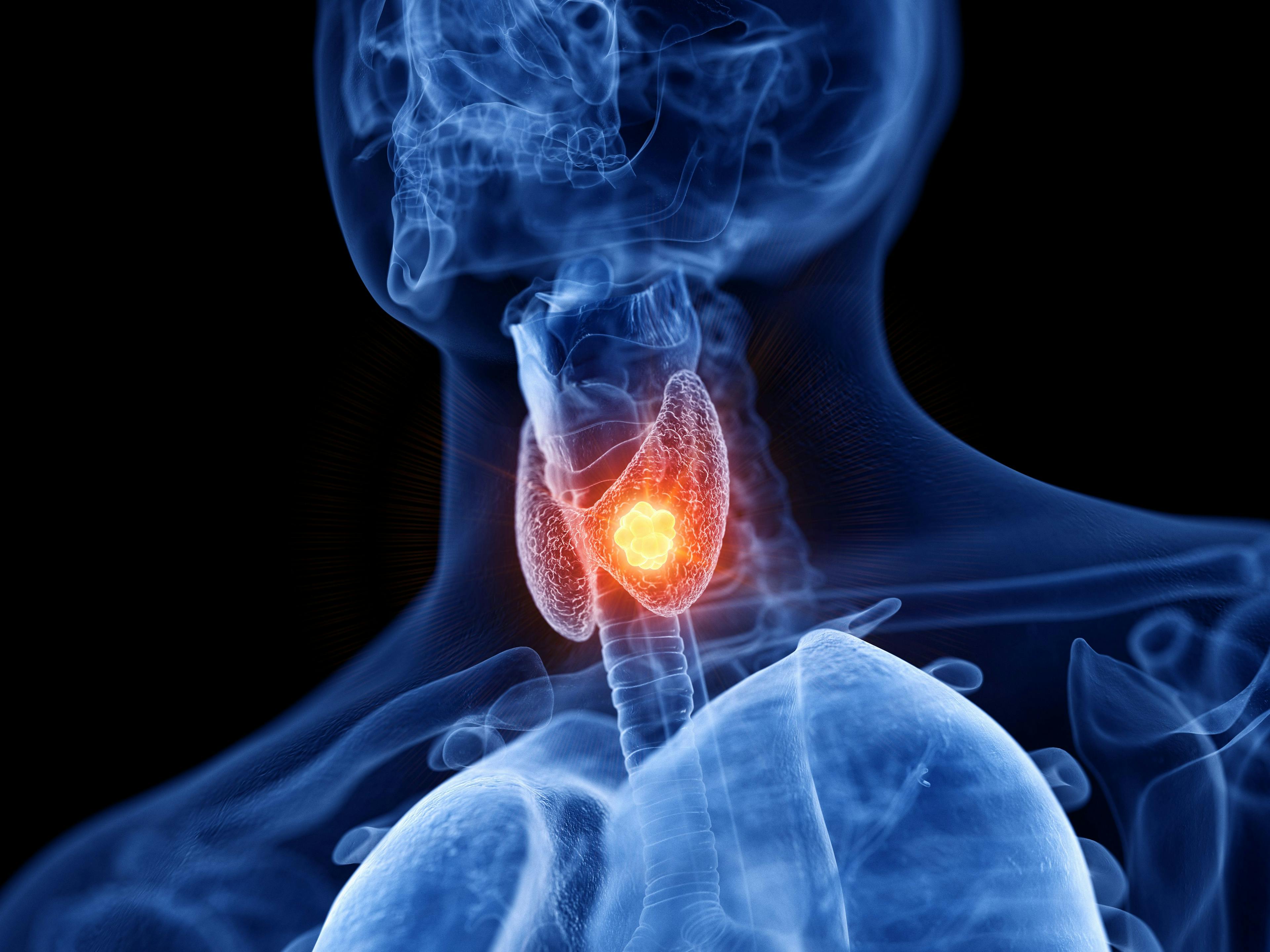 3D rendering of thyroid cancer: ©SciePro - stock.adobe.com
