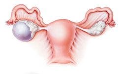 Gynecologic Cancers: Case 2