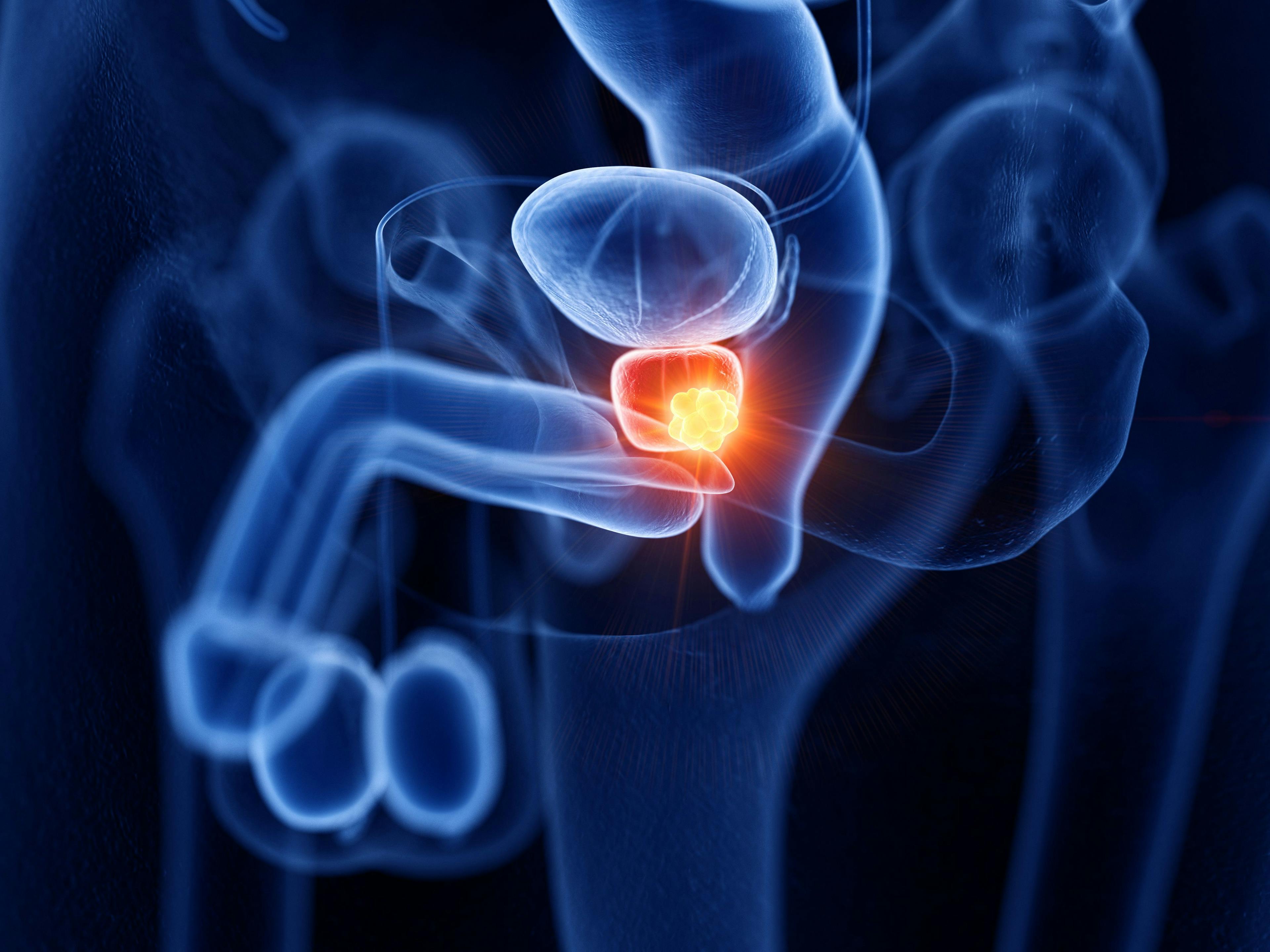 3D rendering of prostate cancer: ©SciePro - stock.adobe.com