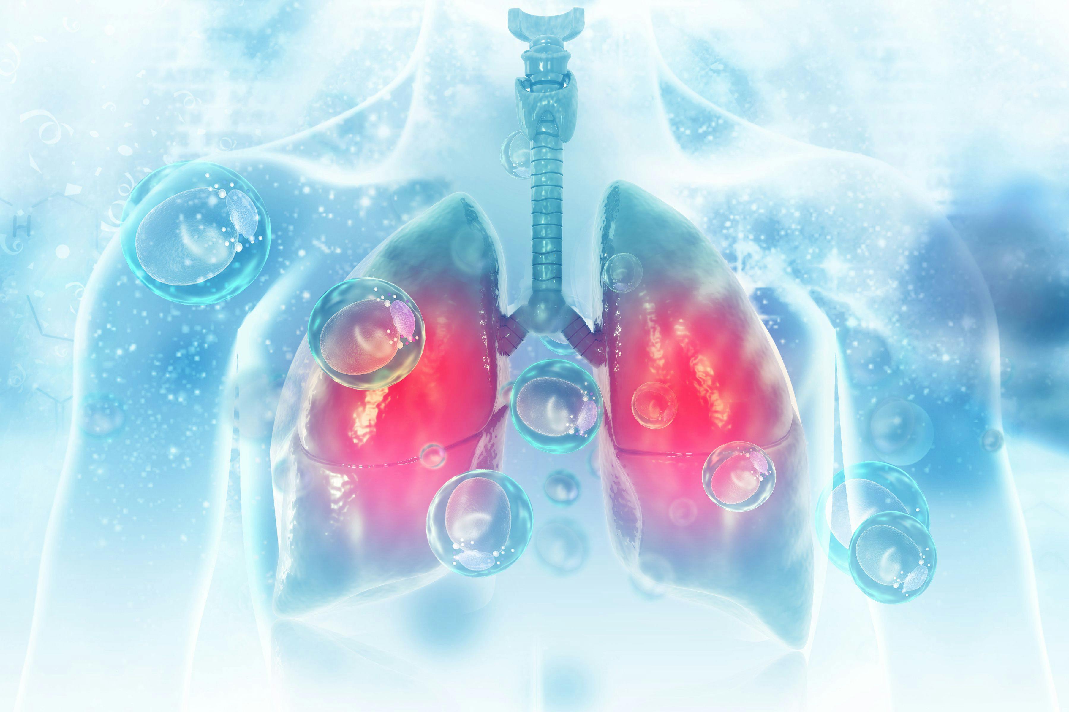 Virus and bacteria infected the Human lungs. lung disease | Image Credit: © Crystal light - www.stock.adobe.com