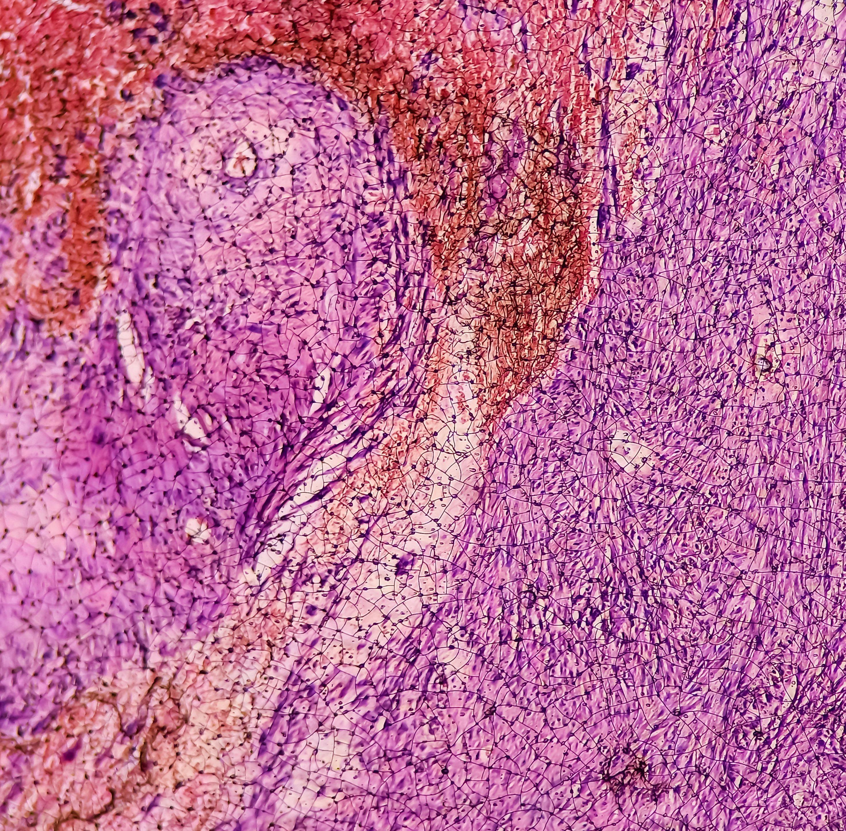 Small intestine mass(biopsy): Malignant gastrointestinal stromal tumor(GIST), Malignant peripheral nerve sheath tumor(MPNST), rare malignant mesenchymal lesion. Neurogenic sarcoma. | Image Credit: © MdBabul -www.stock.adobe.com
