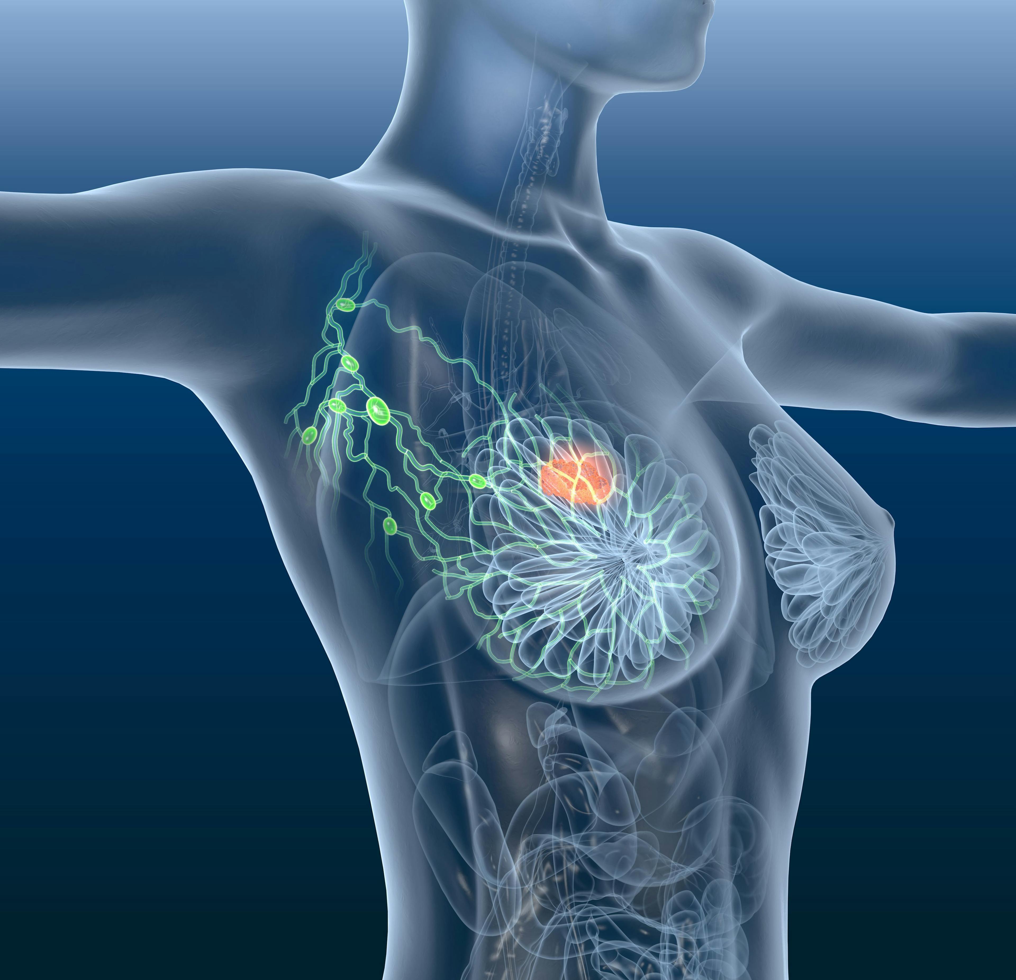 Breast cancer, lymphatics, mastocarcinoma | Image Credit: © Axel Kock - www.stock.adobe.com