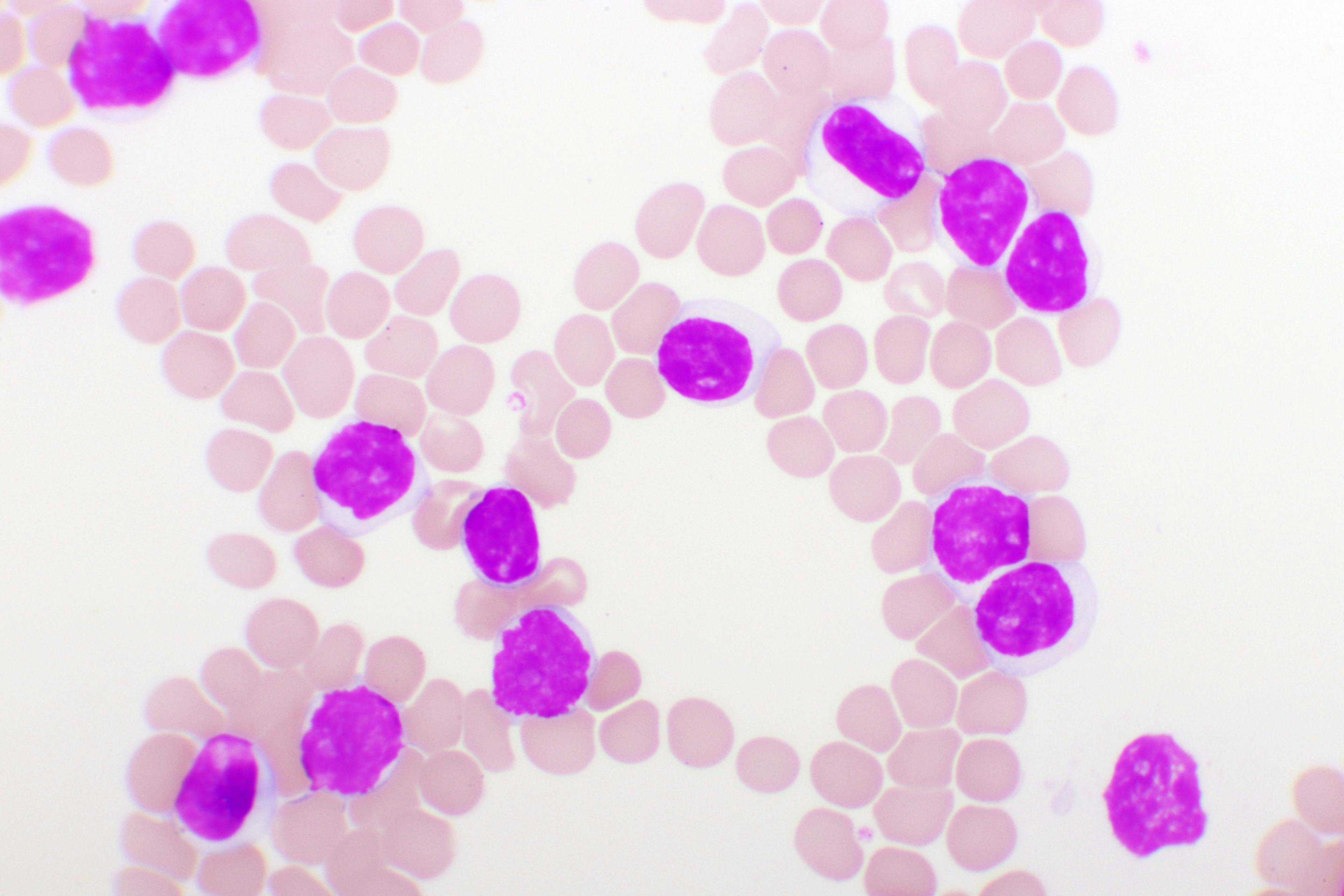 Blood smear of chronic lymphocytic leukemia (CLL), analyze by microscope: © jarun011 - stock.adobe.com


