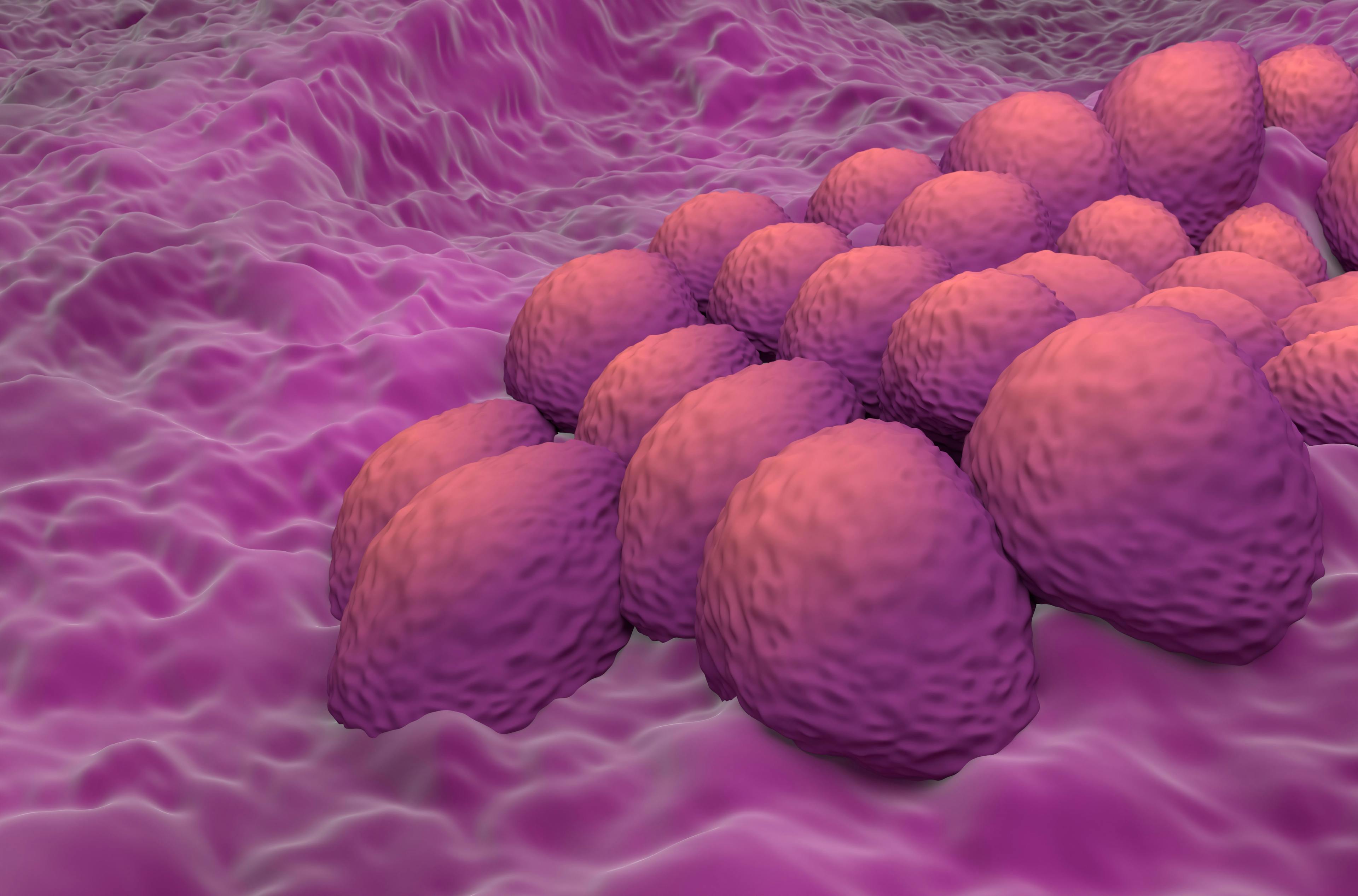 Endometrial cancer cells (adenocarcinoma) in the uterus: ©LASZLO - stock.adobe.com