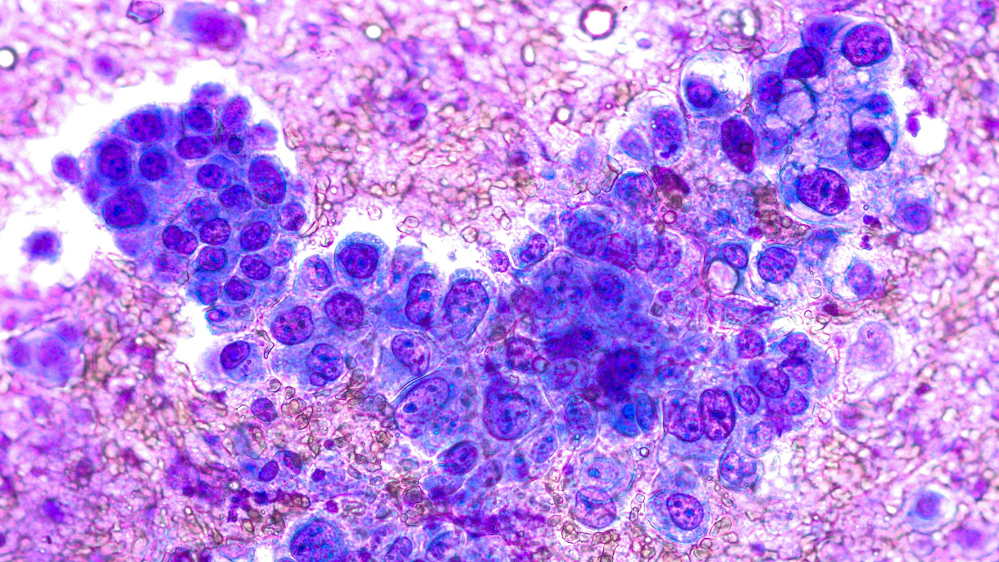 Phogomicrograph of fine needle aspiration (FNA) cytology of a pulmonary (lung) nodule showing adenocarcinoma, a type of non small cell carcinoma. Image Credit: © [ David A Litman] - [Adobe Stock] 