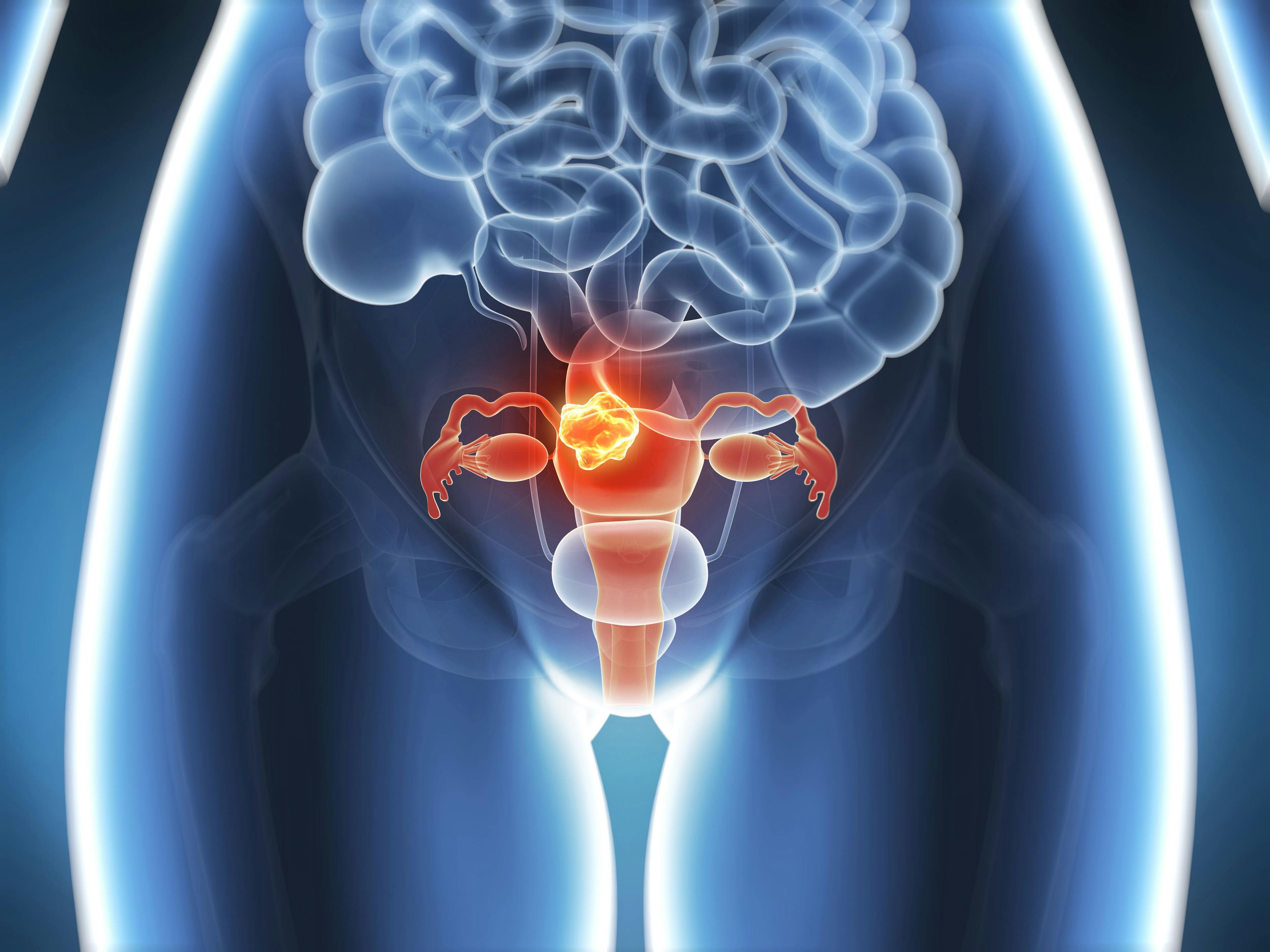 Illustration of gynecologic cancer - stock.adobe.com