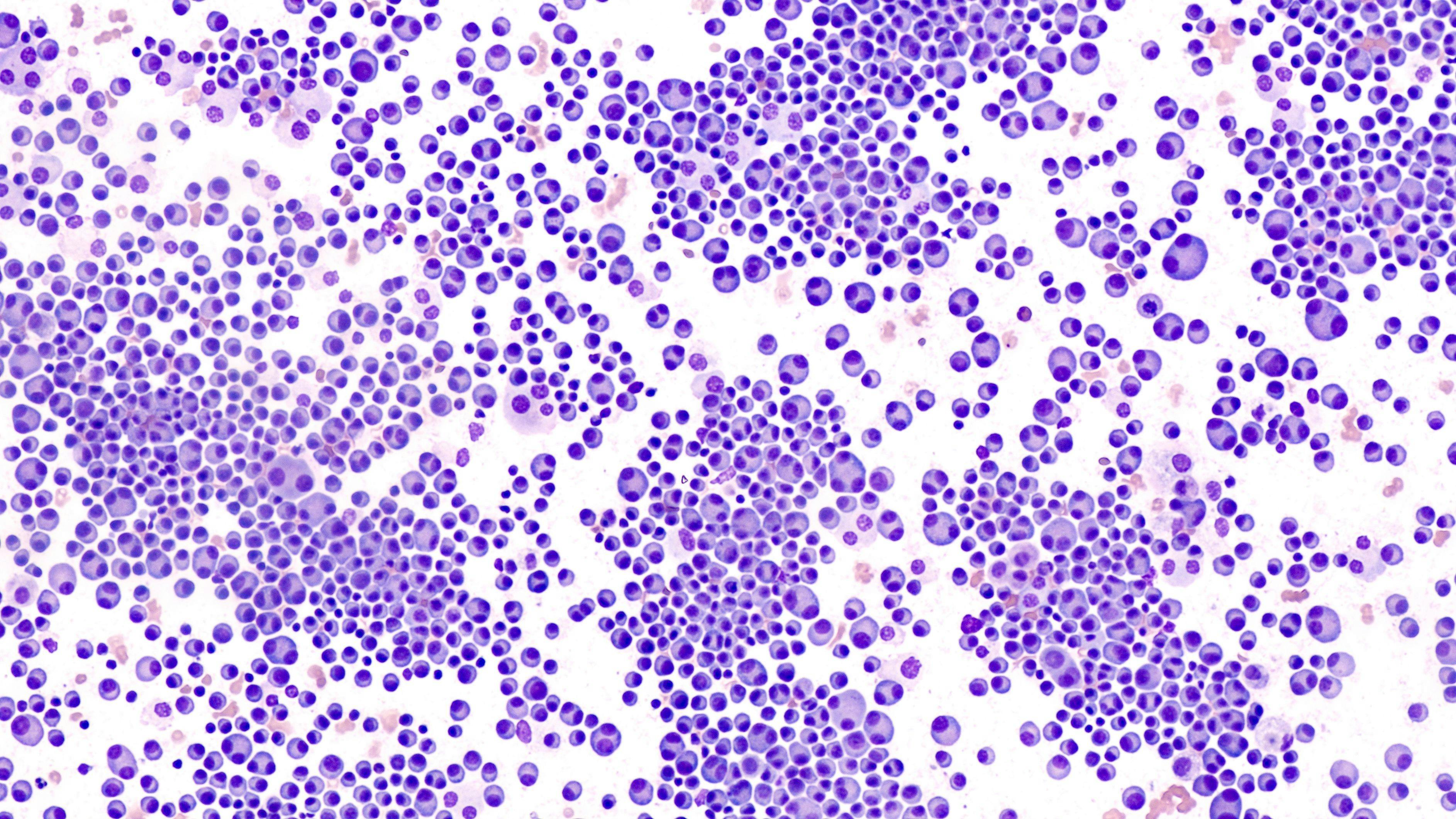 Multiple Myeloma Awareness: Bone marrow aspirate cytology of multiple myeloma, a type of bone marrow cancer of malignant plasma cells, associated with bone pain, bone fractures and anemia. |  Image Credit: © David A Litman - www.stock.adobe.com
