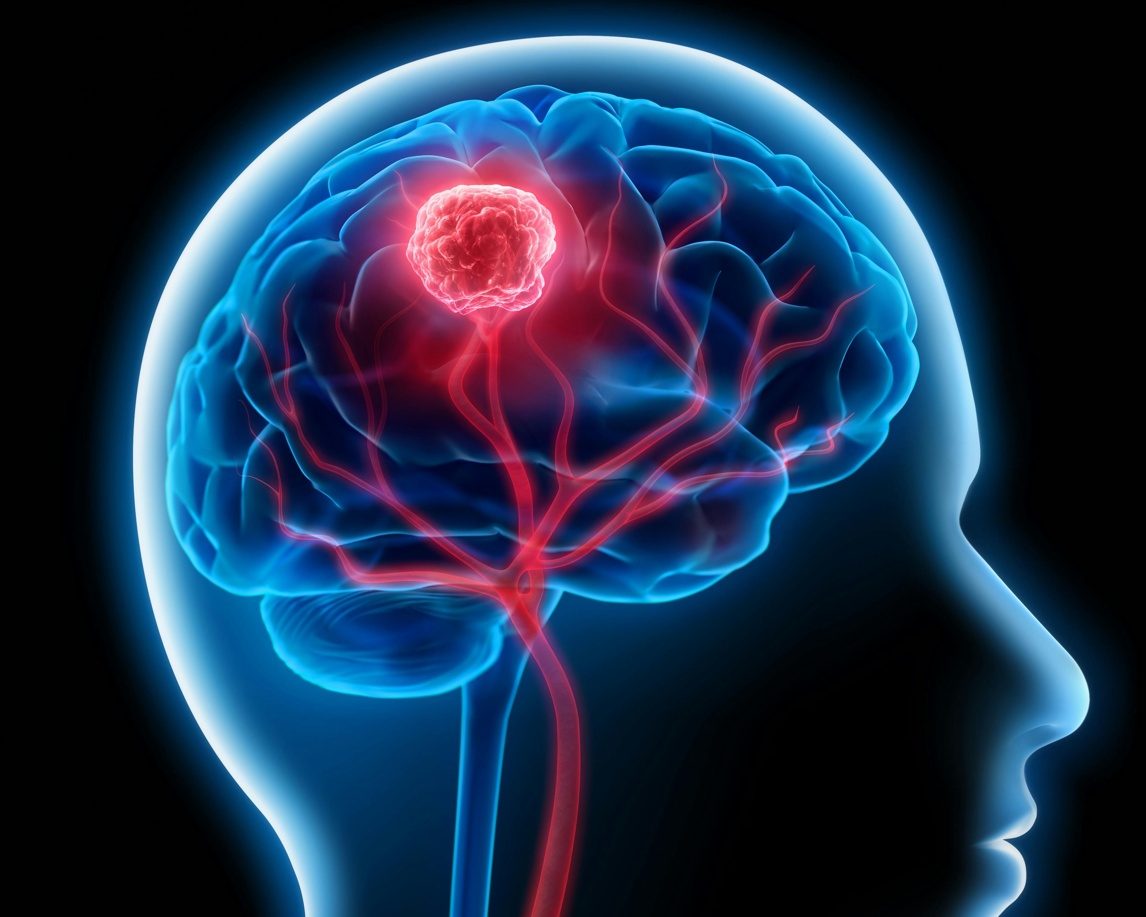 Tumor in brain: © peterschreiber.media - stock.adobe.com