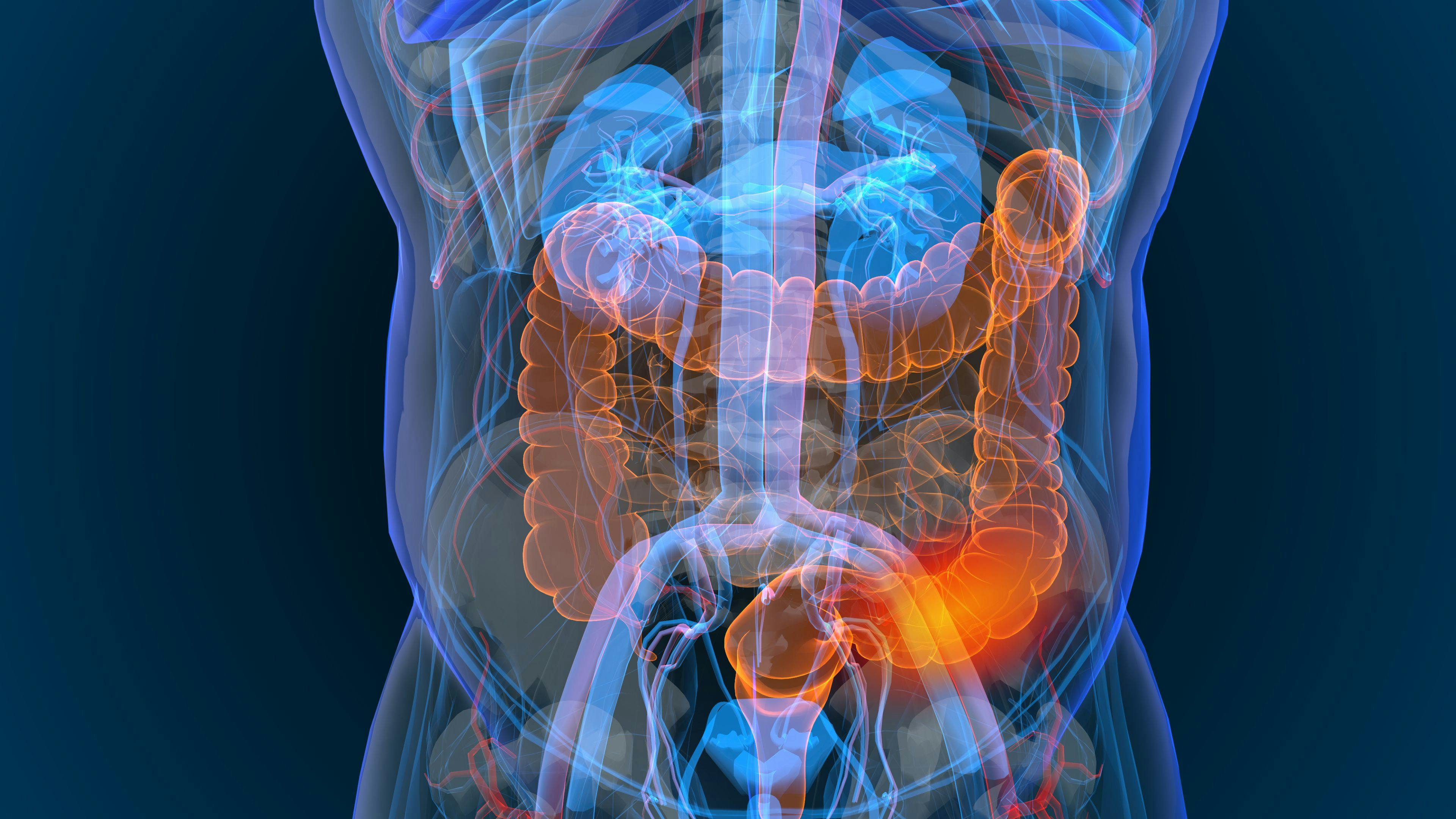 [3d rendered illustration of bowel cancer 3D illustration]  Image Credit © [appledesign] - [Adobe Stock]