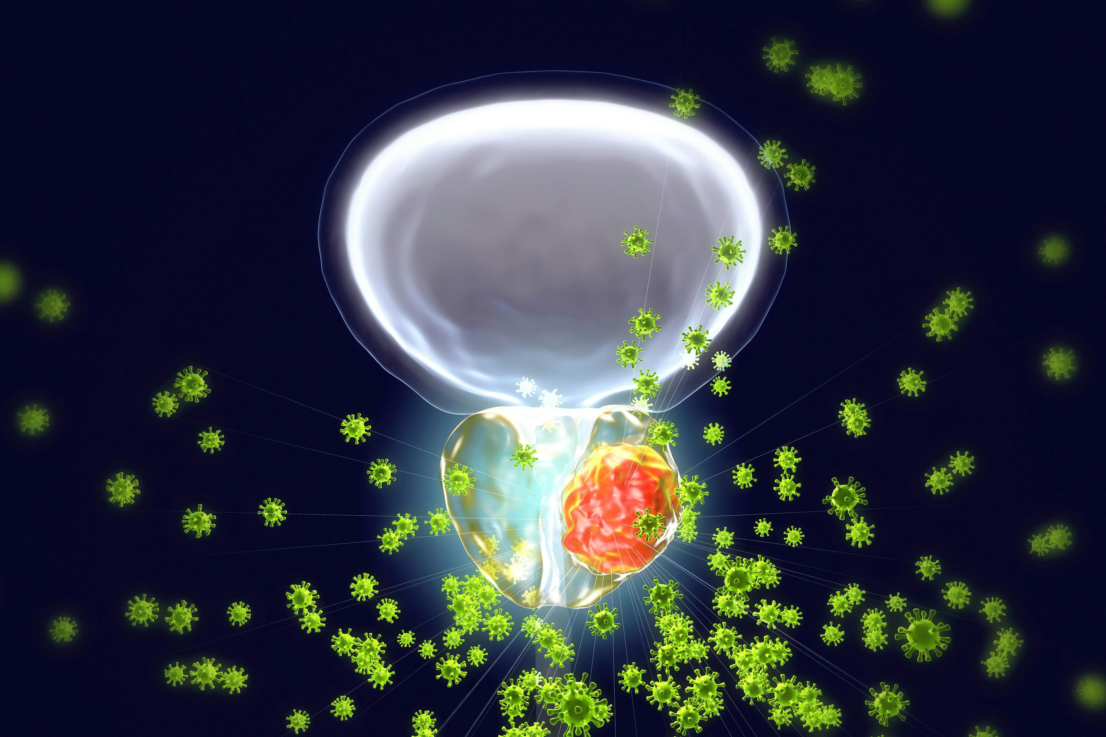 Conceptual image for viral ethiology of prostate cancer. 3D illustration showing viruses infecting prostate gland which develops cancerous tumor: © Dr_Microbe - stock.adobe.com
