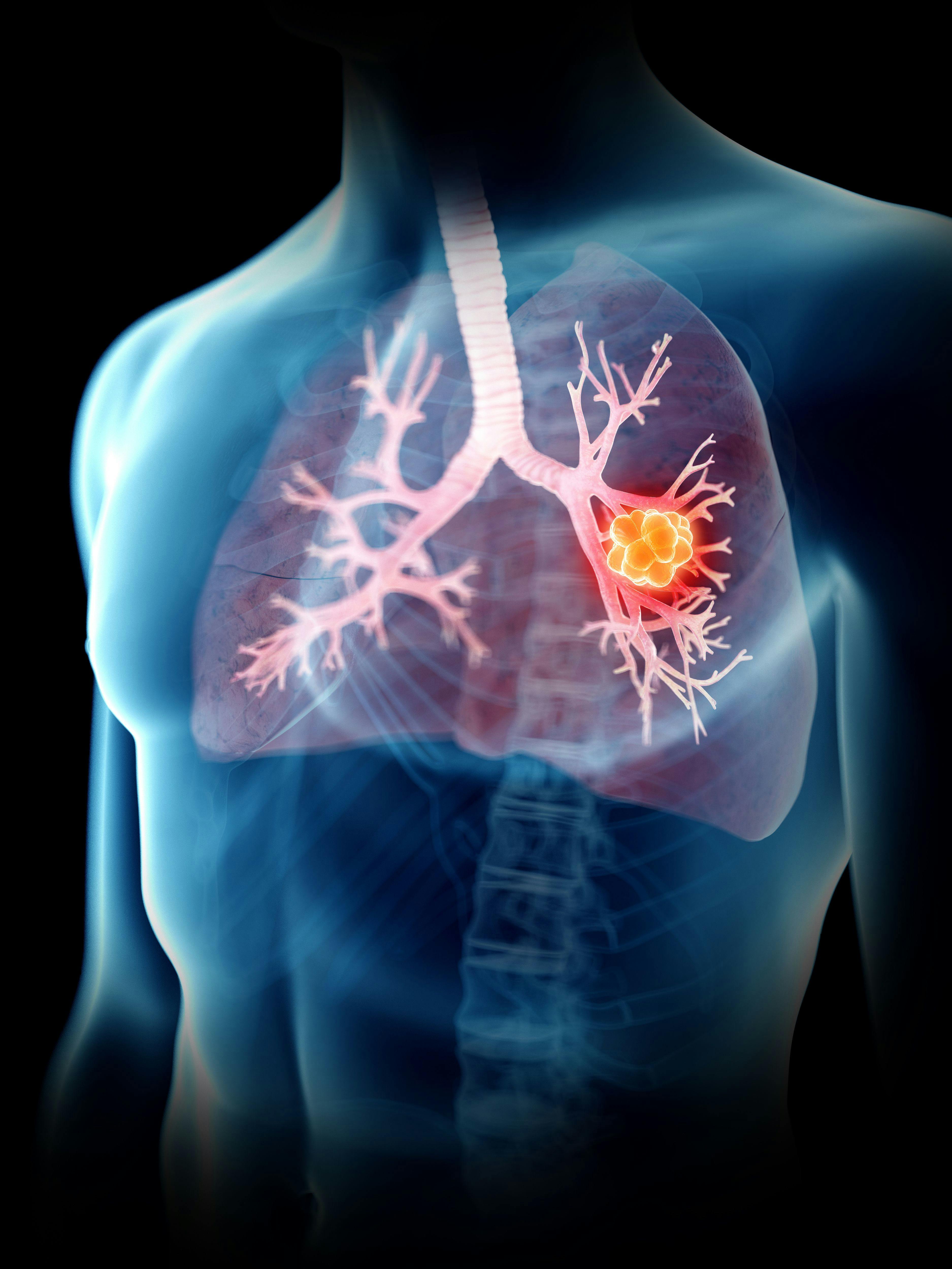 3d rendered medically accurate illustration of a lung tumor: © SciePro - stock.adobe.com