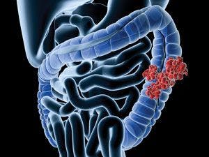 TAS-102 (tipiracil hydrochloride) has received a fast track designation from the FDA as a treatment for patients with refractory metastatic colorectal cancer (mCRC).