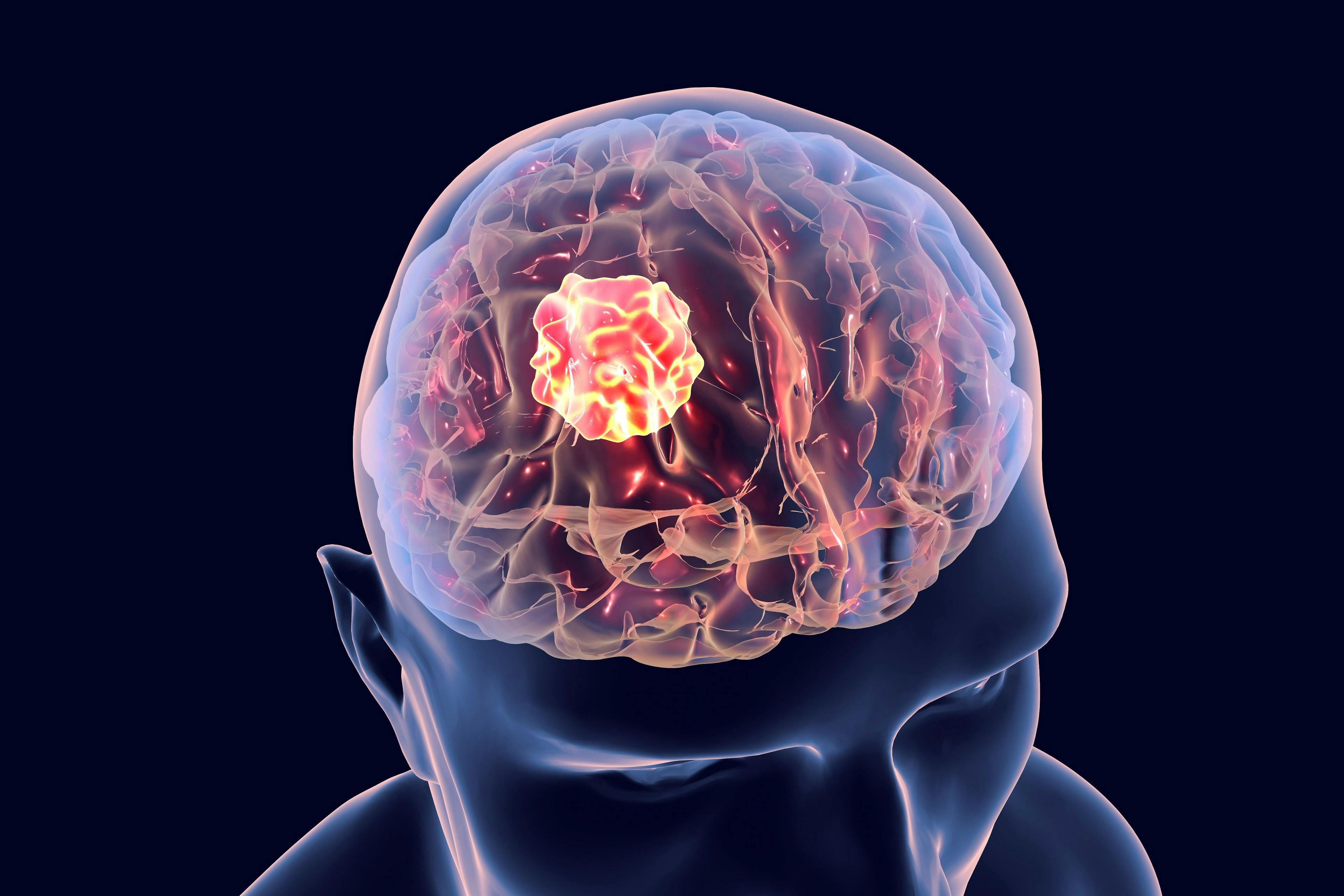 Brain cancer, 3D illustration showing presence of tumor inside brain: © Dr_Microbe - stock.adobe.com