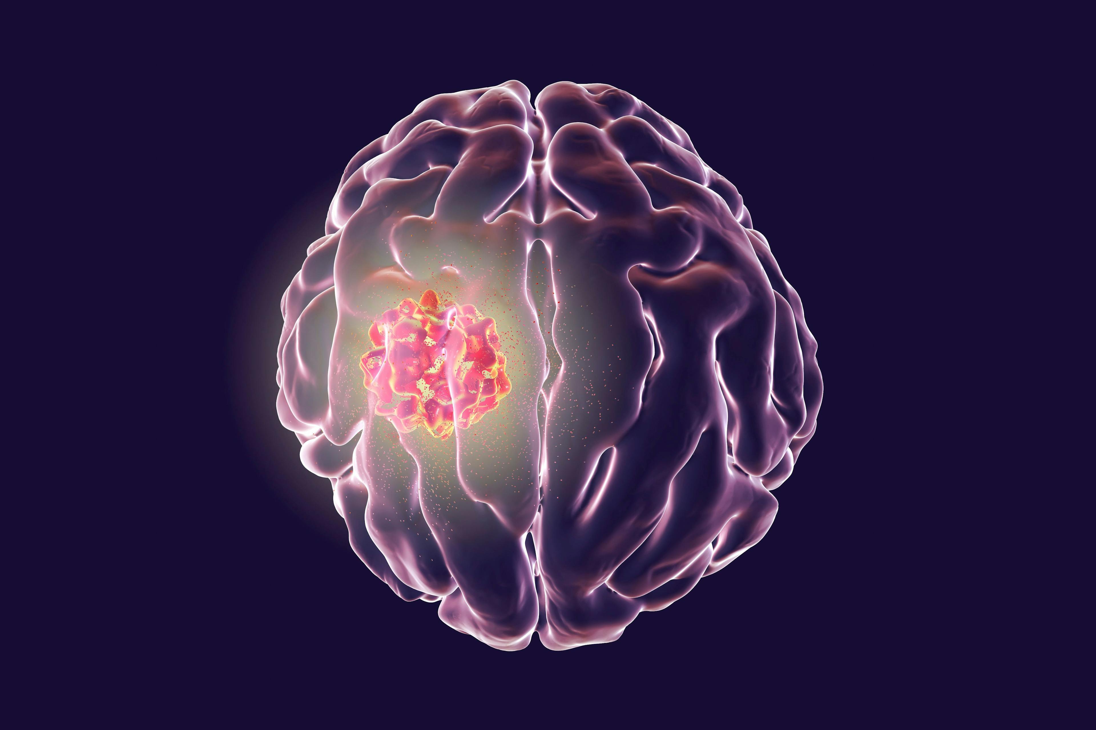 Destruction of brain tumor, 3D illustration. Conceptual image for brain cancer treatment: ©Dr_Microbe - stock.adobe.com
