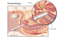 Targeted Biopsies Detect More High-Risk Prostate Cancers Than Standard Biopsies