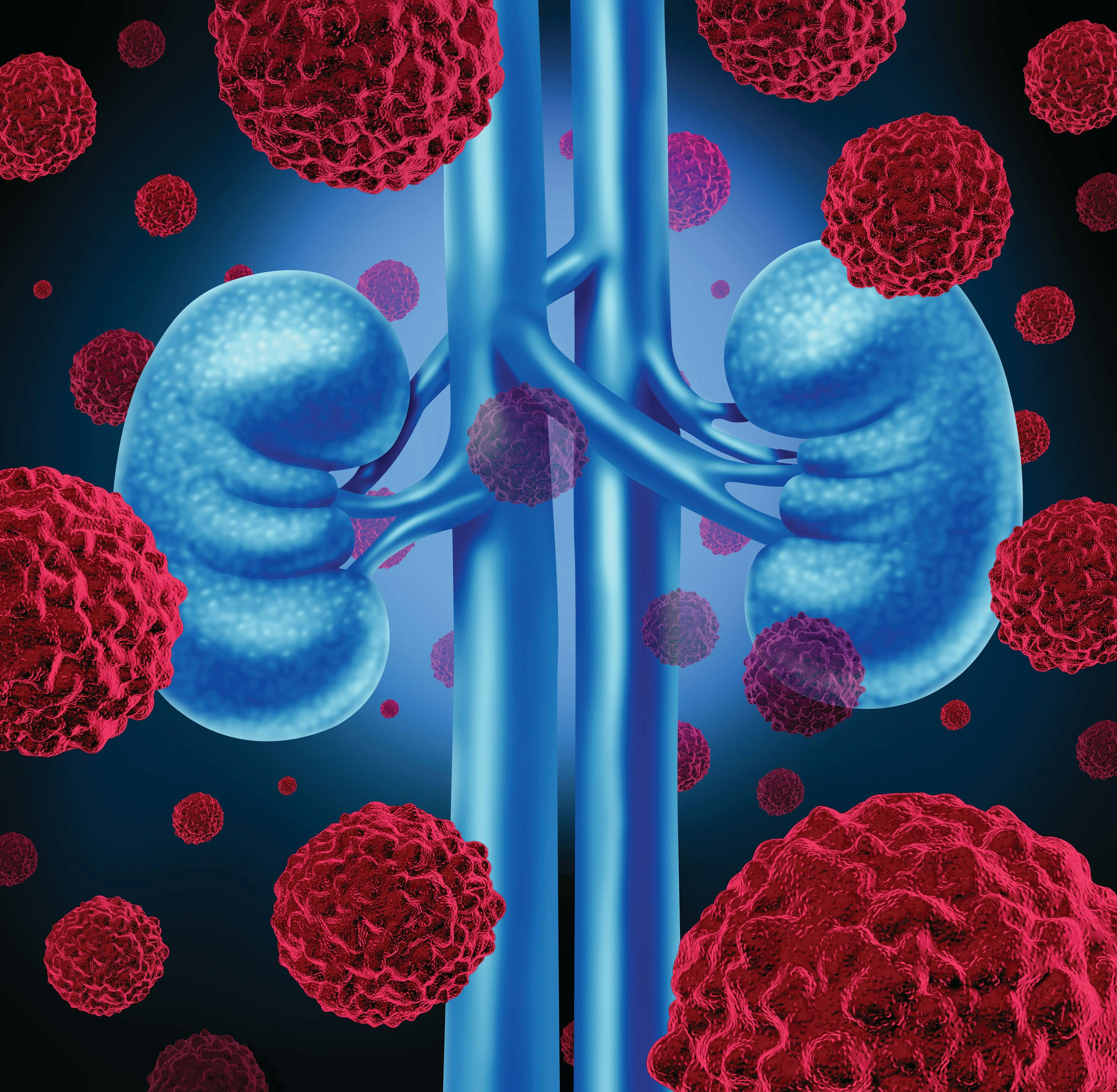 Illustration of kidney cancer