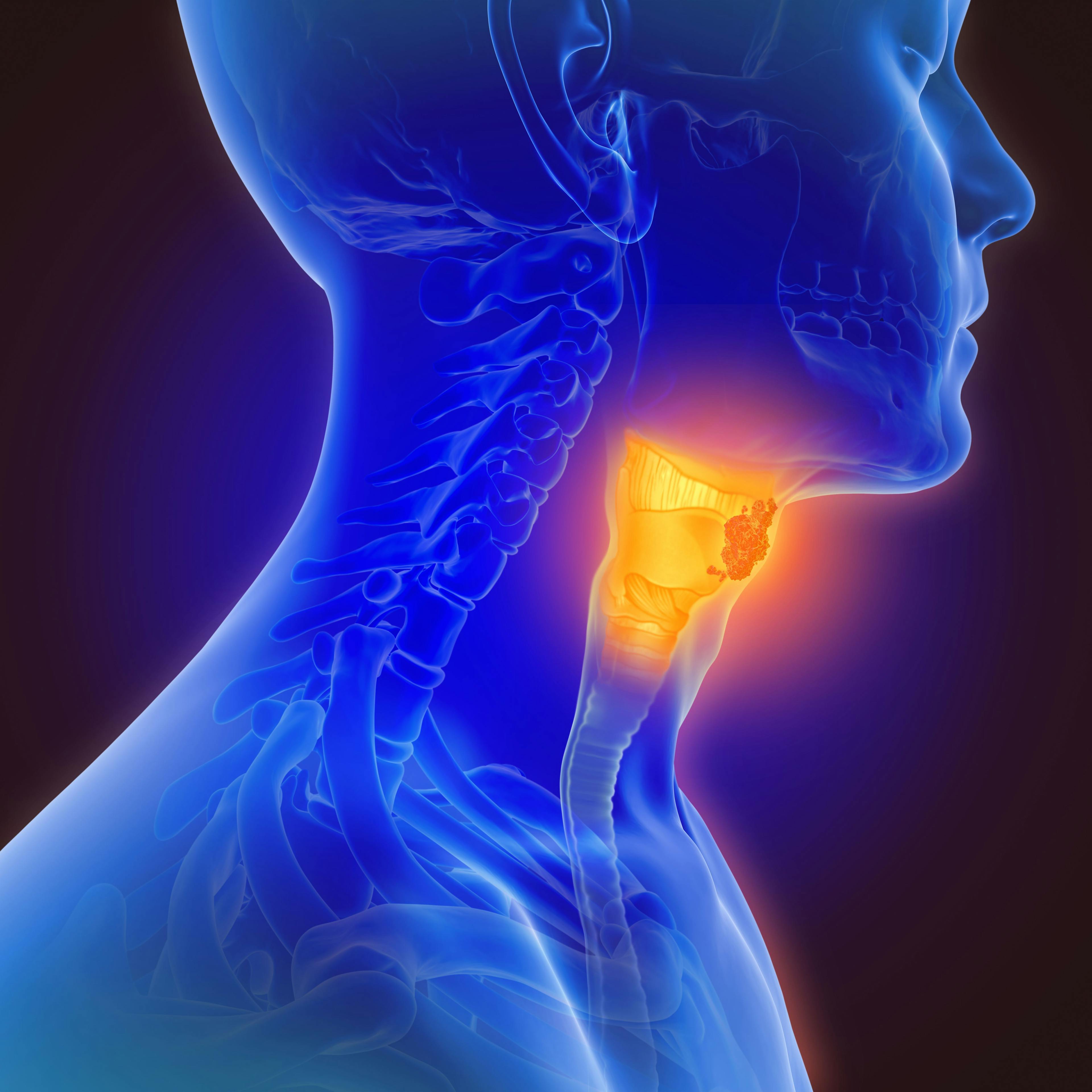 3d illustration of throat cancer | Image Credit: © Lars Neumann - www.stock.adobe.com