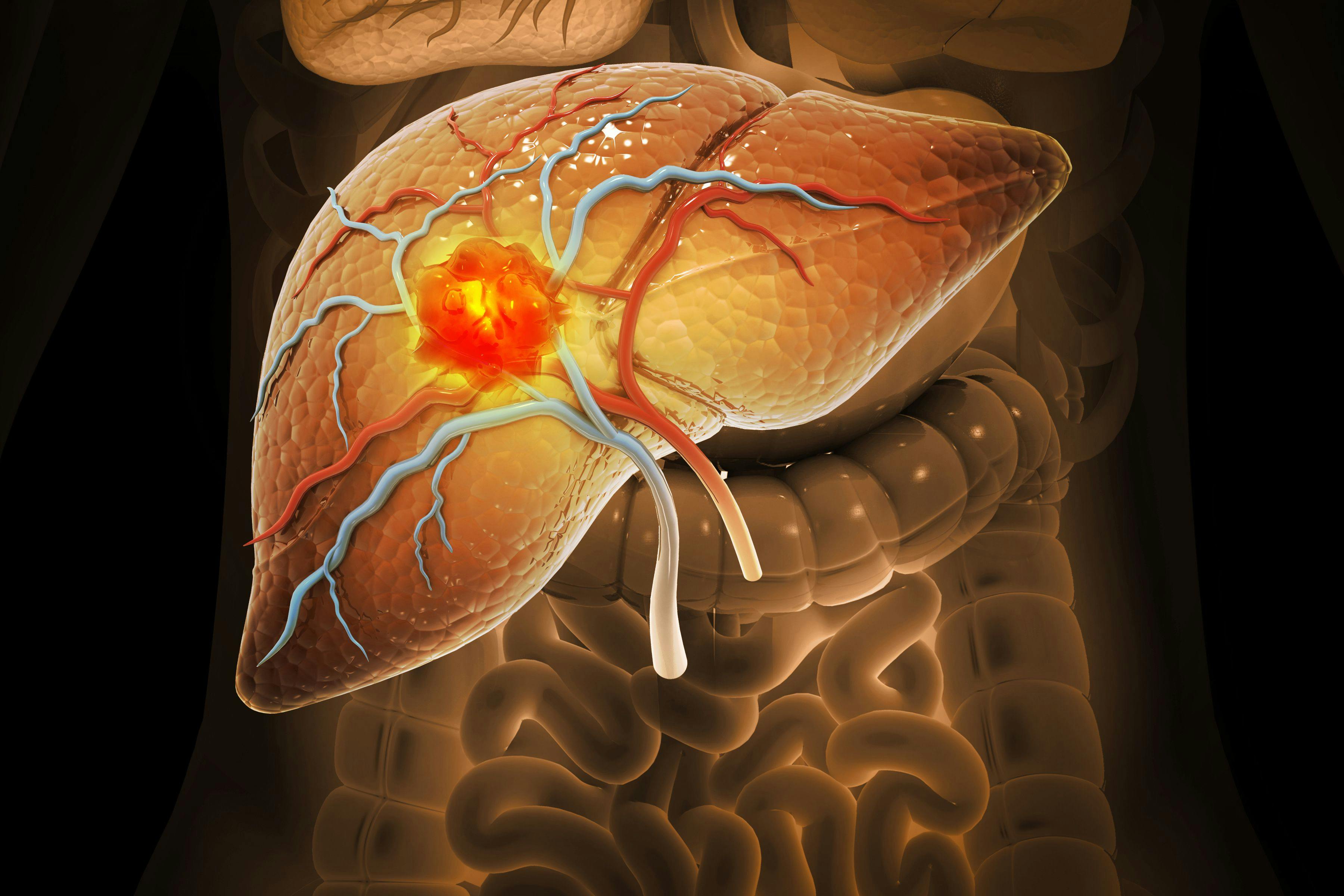 Liver cancer, Hepatocellular Carcinoma (HCC), conditions, causes and treatment. 3d illustration | Image Credit:  Crystal light - www.stock.adobe.com