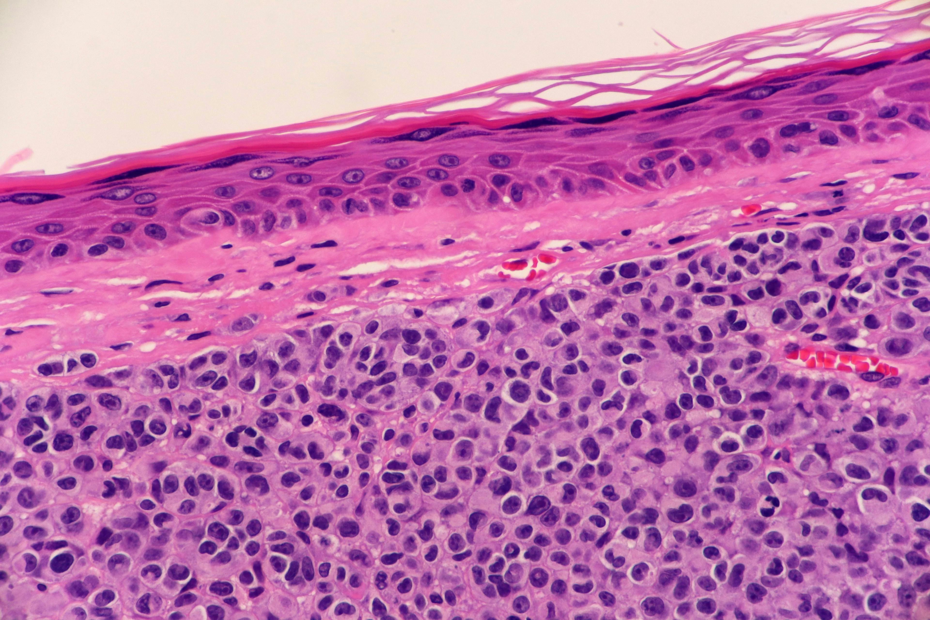 Image Credit: © Lisa - www.stock.adobe.com| A malignant skin cancer called nodular melanoma, just beneath the epidermis. Microscopic view.