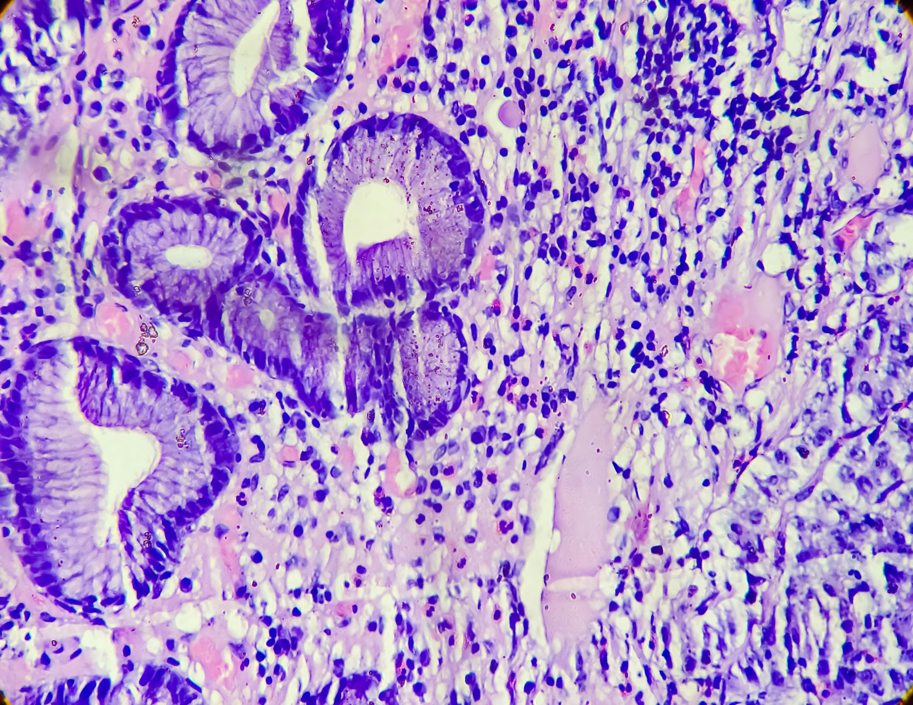 Photomicrograph of a carcinoid tumor, a type of neuroendocrine tumor (NET), which presented as a gastric polyp, 100x view | Image Credit: © MdBabul - www.stock.adobe.com