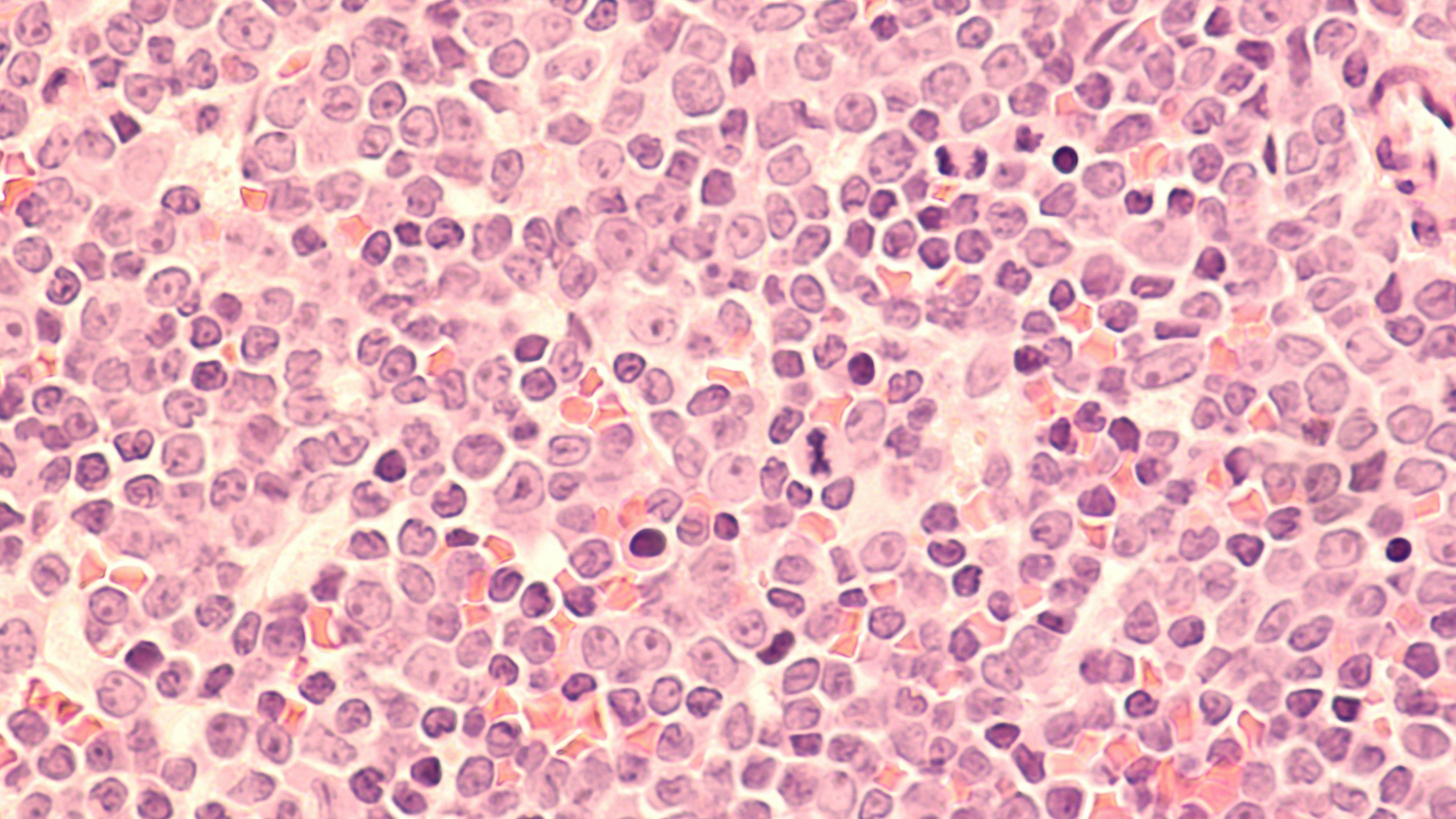 A staging bone marrow biopsy shows replacement of normal elements by diffuse large B-cell lymphoma, a type of non Hodgkin lymphoma, a malignancy (cancer) of lymphocytes, in this case spread to bone. | Image Credit: David A Litman - www.stock.adobe.com