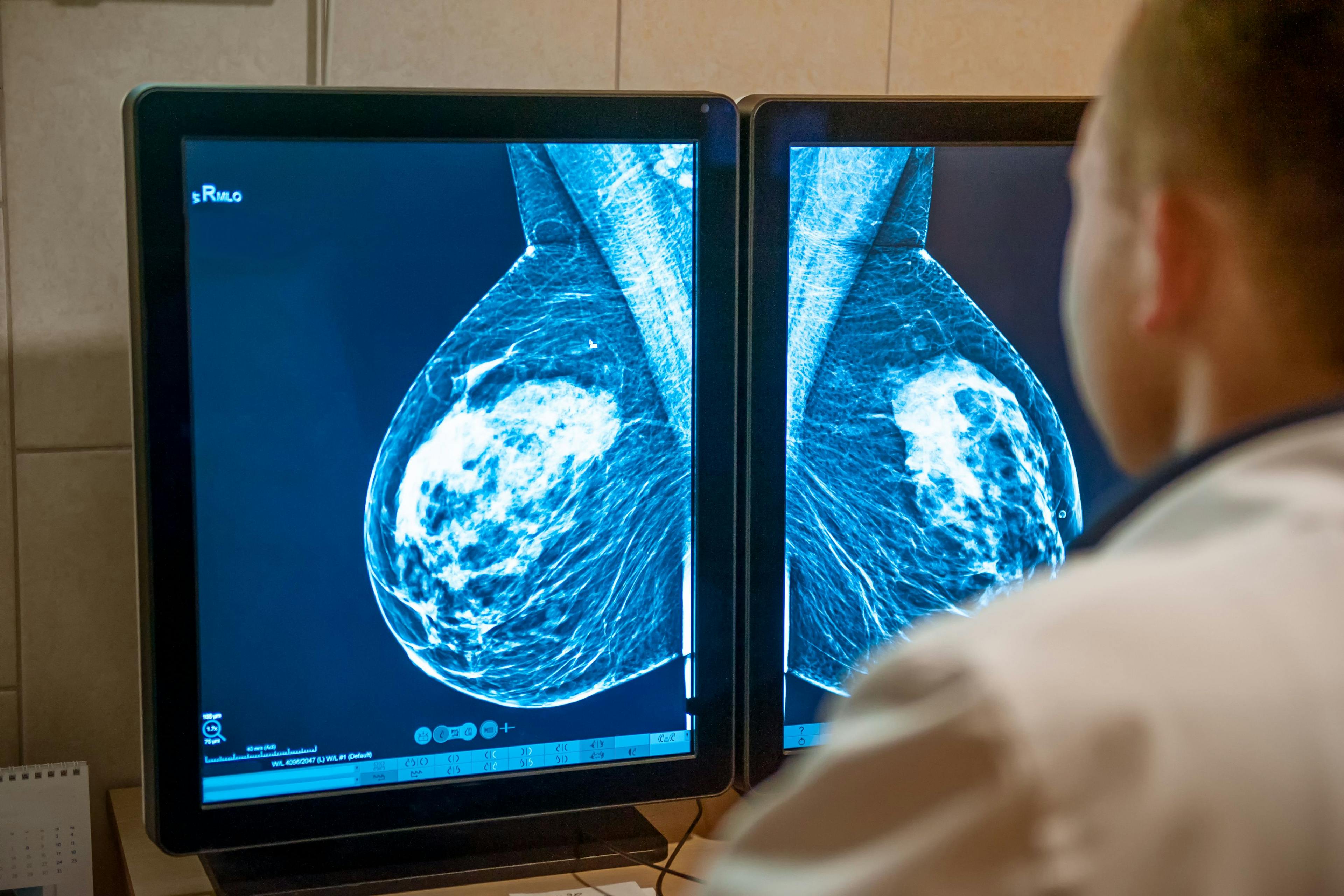 Doctor examines mammogram snapshot of breast of female patient on the monitors. Selective focus. | Image Credit: © okrasiuk - www.stock.adobe.com