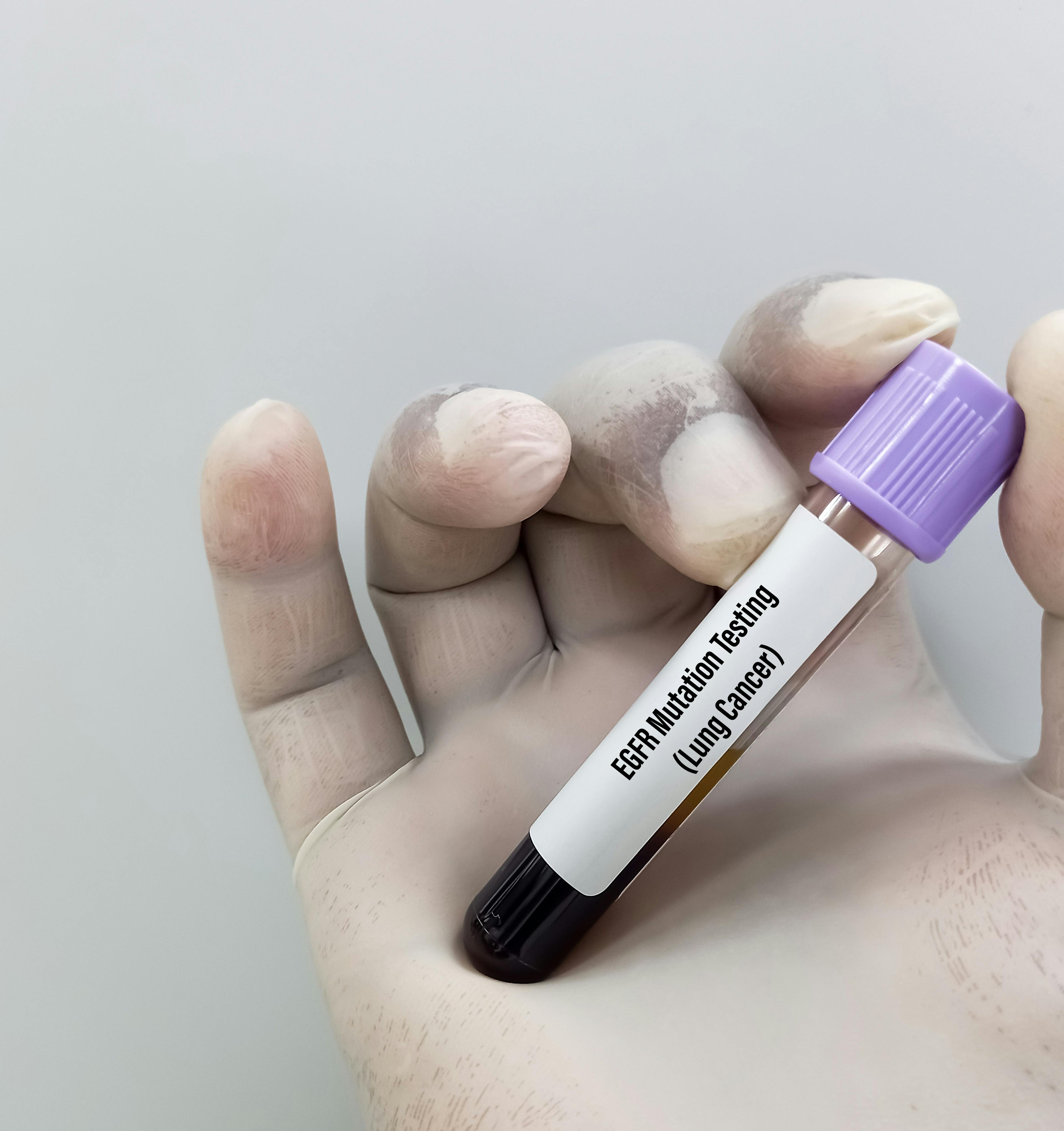 Molecular biologist holding blood sample for EGFR mutation test for the diagnosis of lung disease. Epidermal Growth Factor Receptor. | Image Credit: © MdBabul - www.stock.adobe.com