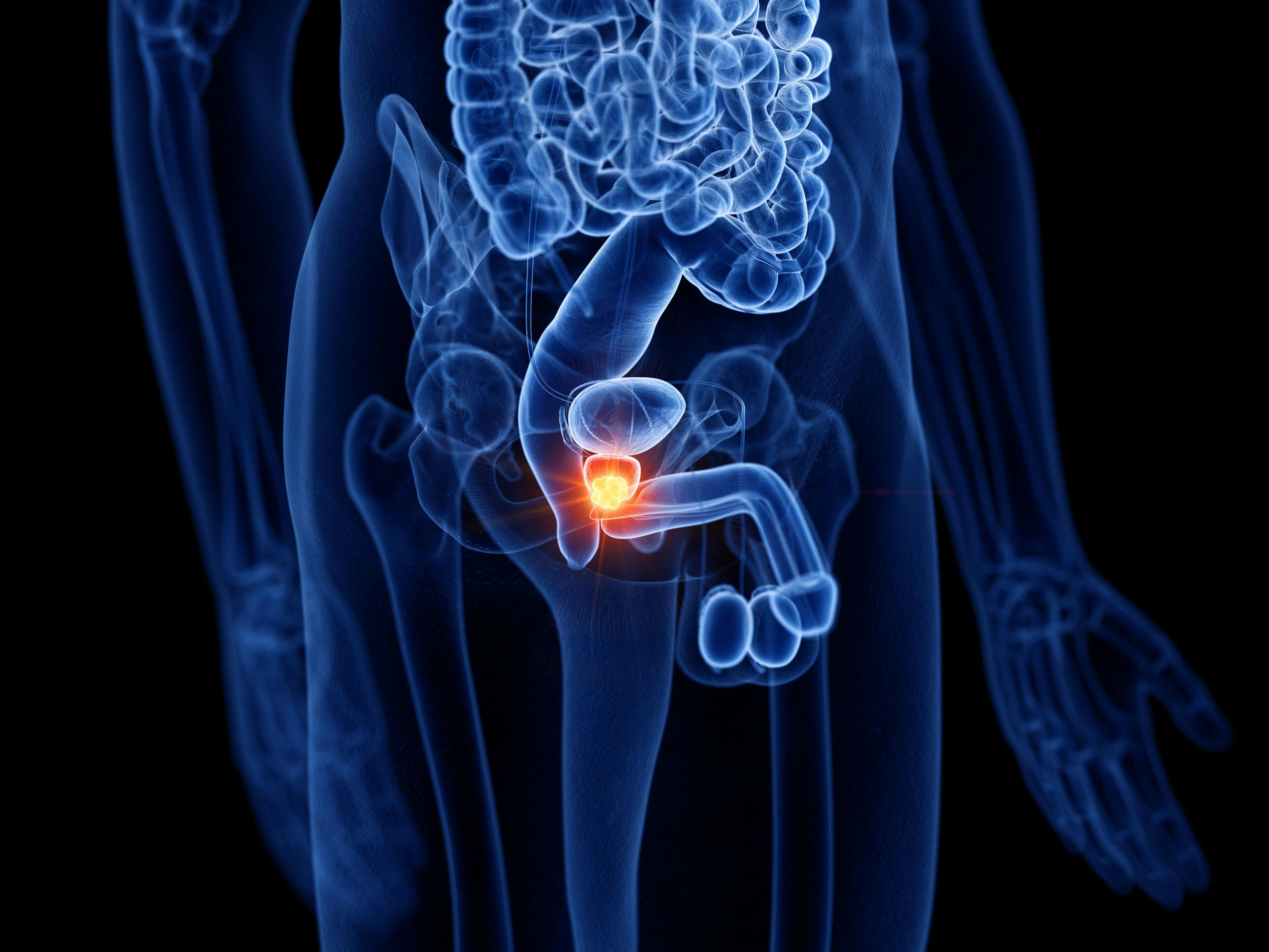 3d rendered medically accurate illustration of prostate cancer: © SciePro - stock.adobe.com