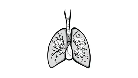 Unecritinib Shows Efficacy as ROS1-Directed Therapy in NSCLC