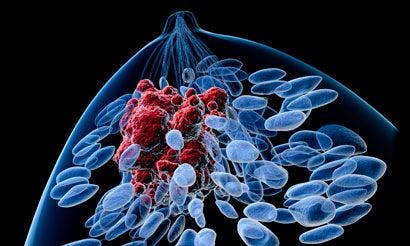 Palbociclib Improves PFS in Phase III Breast Cancer Study