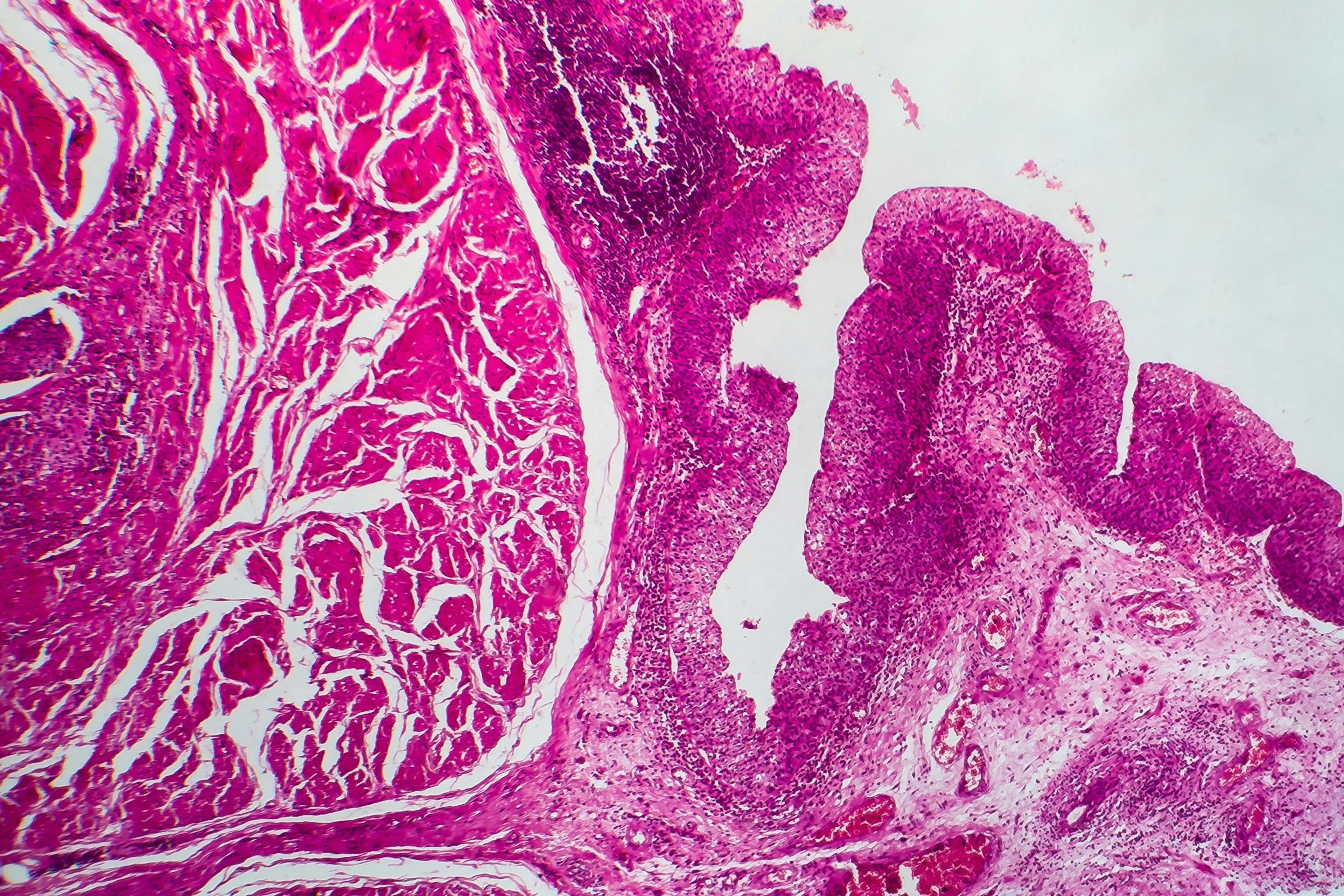 Bladder cancer, light micrograph, photo under microscope | Image Credit: © Dr_Microbe - www.stock.adobe.com