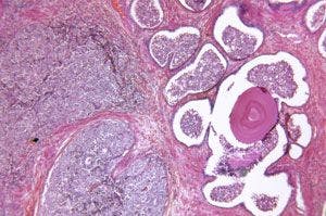 Prostate Cancer Cells