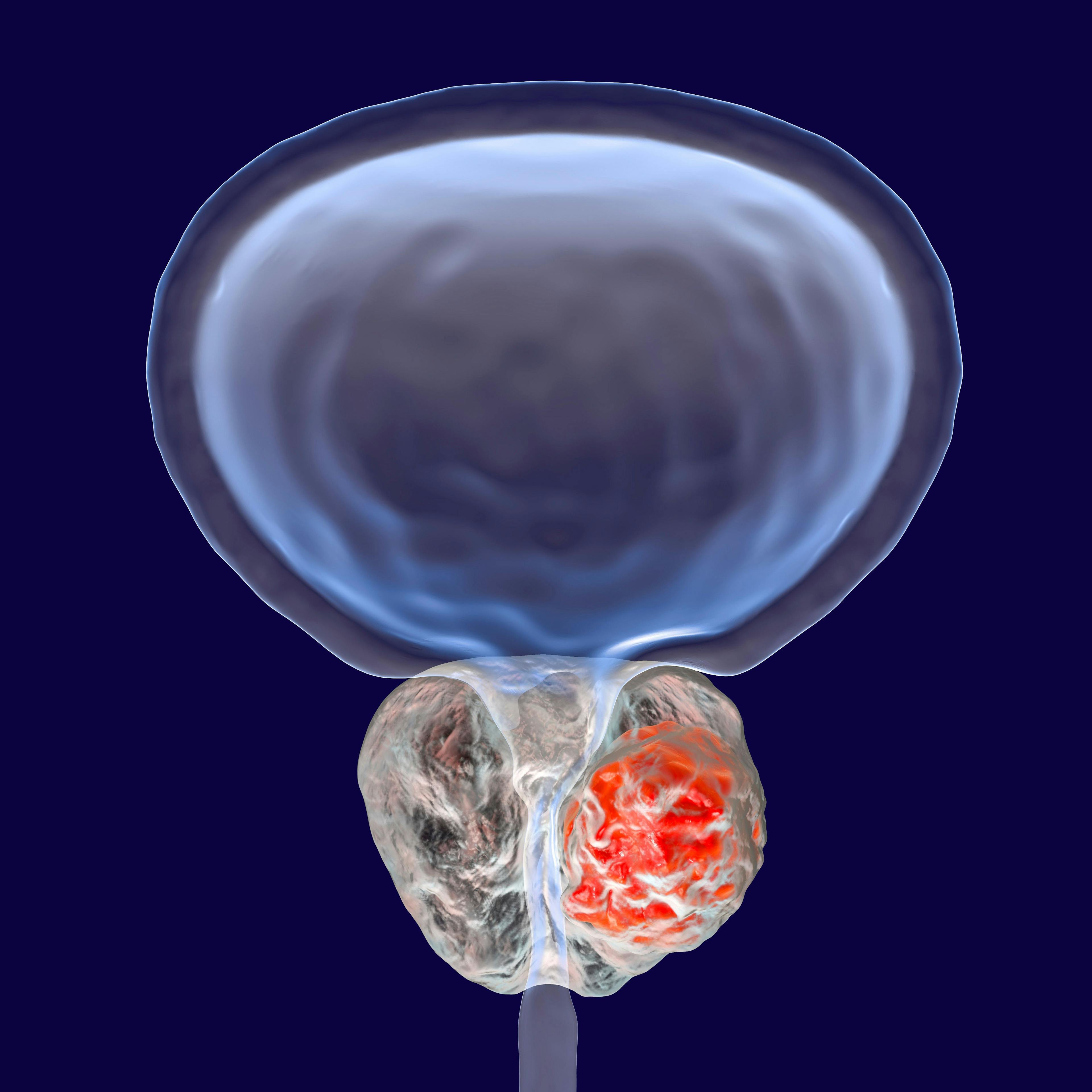 3D illustration showing presence of tumor inside prostate gland © Dr_Microbe - stock.adobe.com