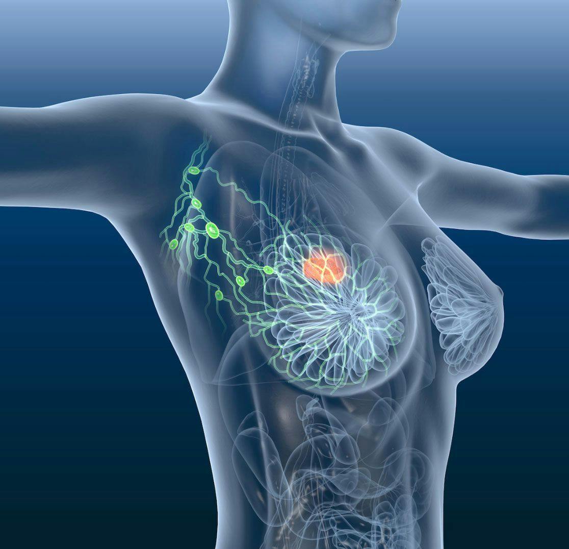 Image of breast cancer