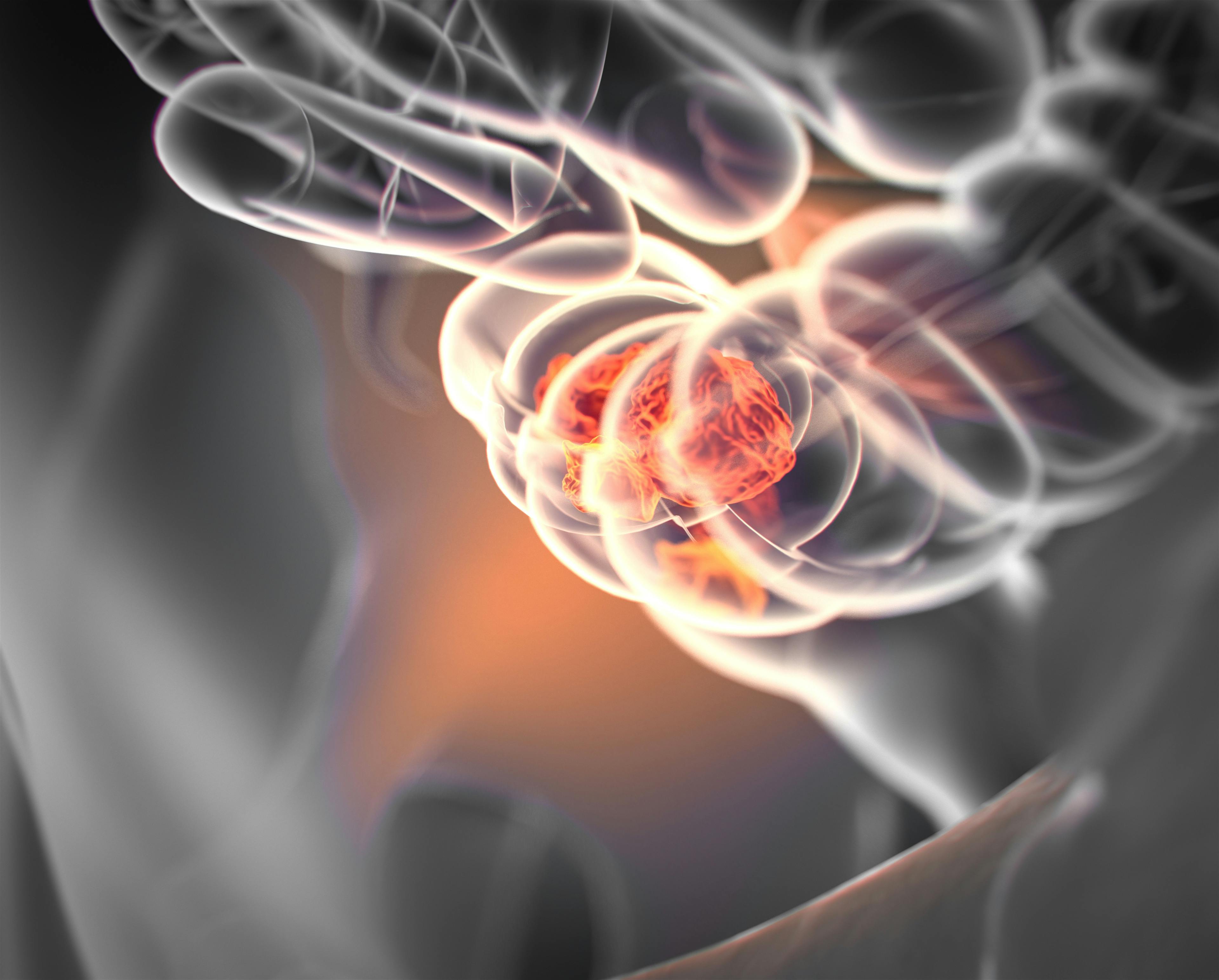 3D medical illustration of colorectal cancer: © anatomy insider - stock.adobe.com