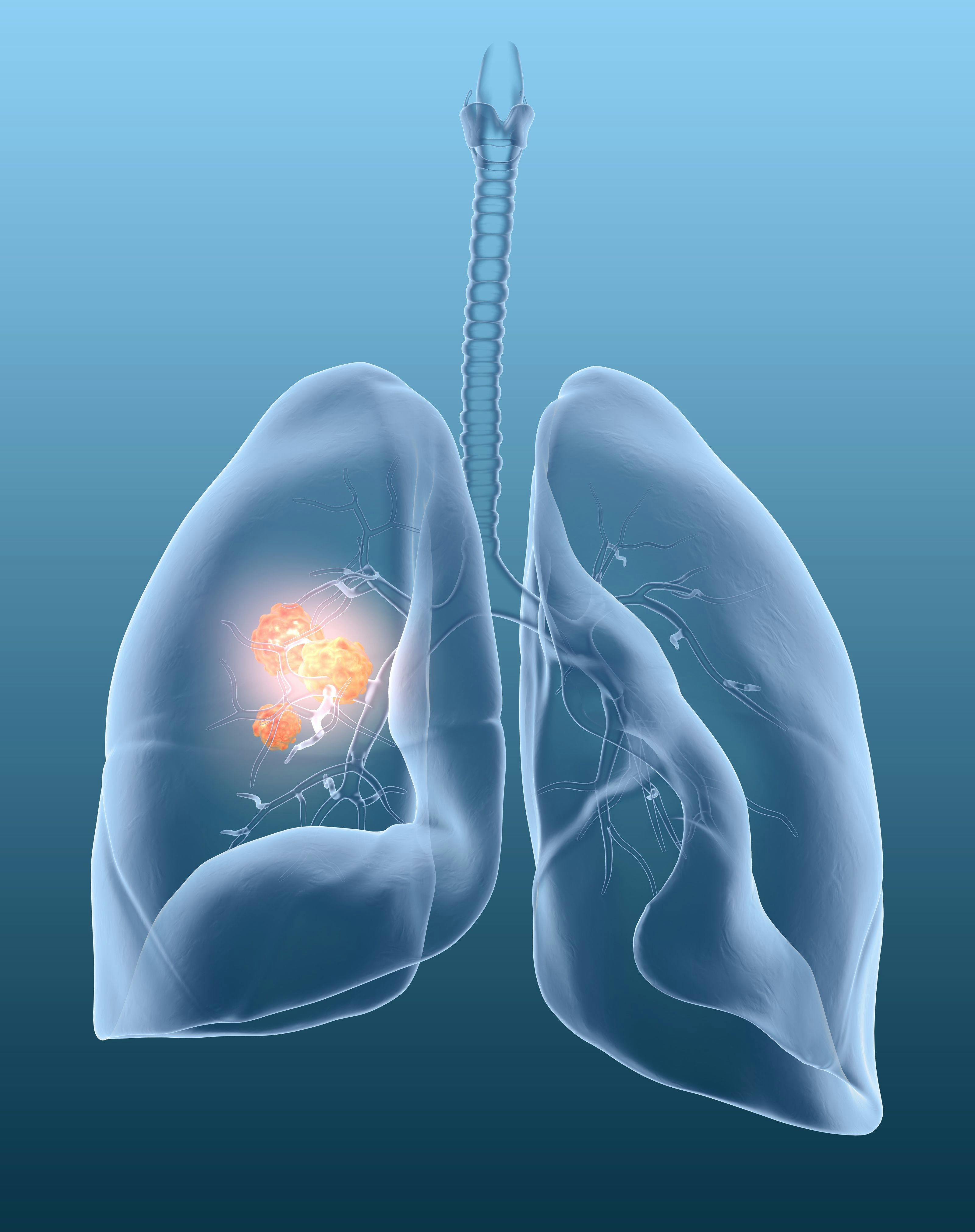 lung cancer image