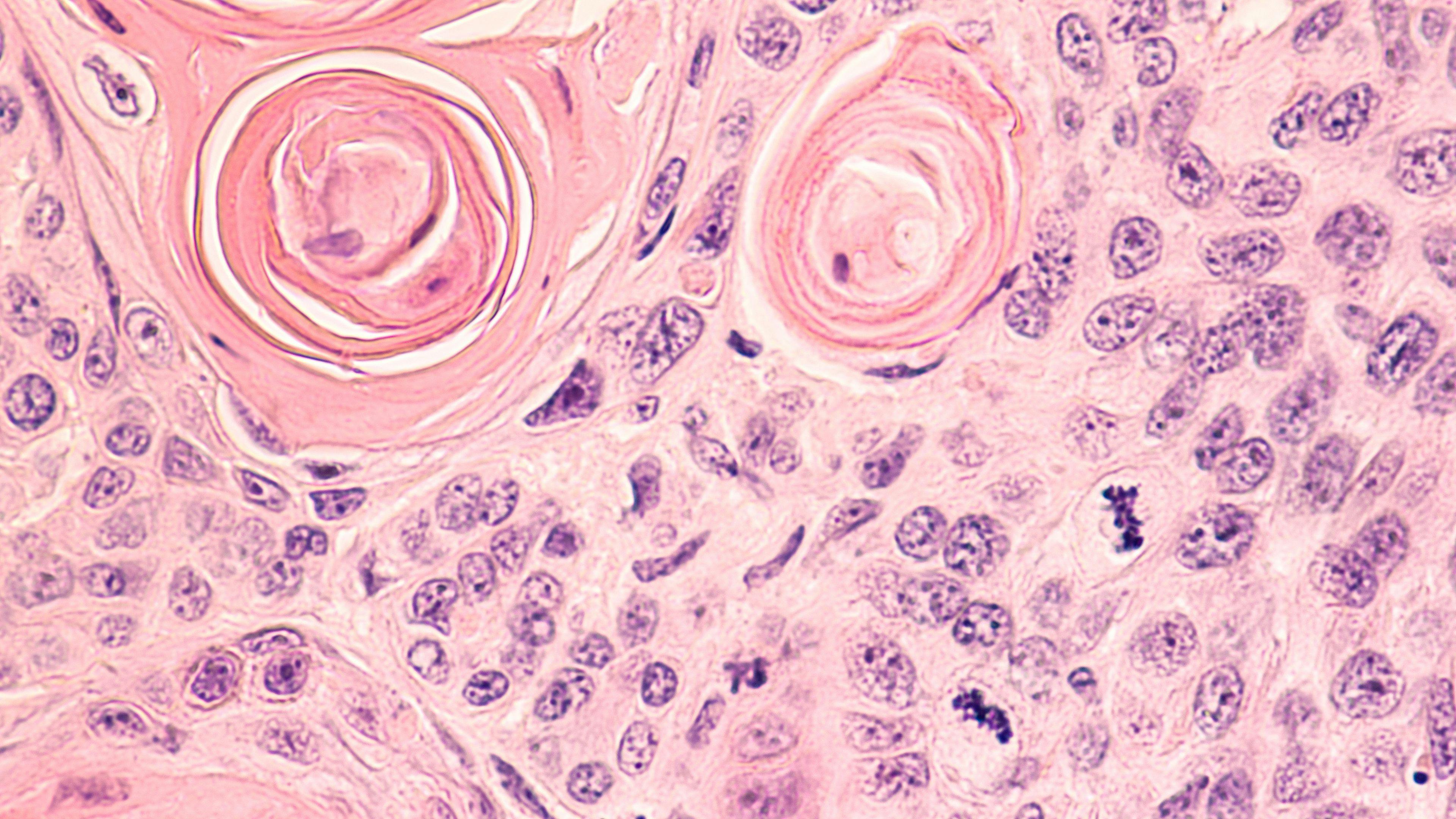 Lung Cancer: Photomicrograph of a CT (CAT) scan-guided needle core biopsy showing pulmonary squamous cell carcinoma, a type of non-small cell carcinoma usually associated with ... See More | Image Credit: © David A. Litman -www.stock.adobe.com