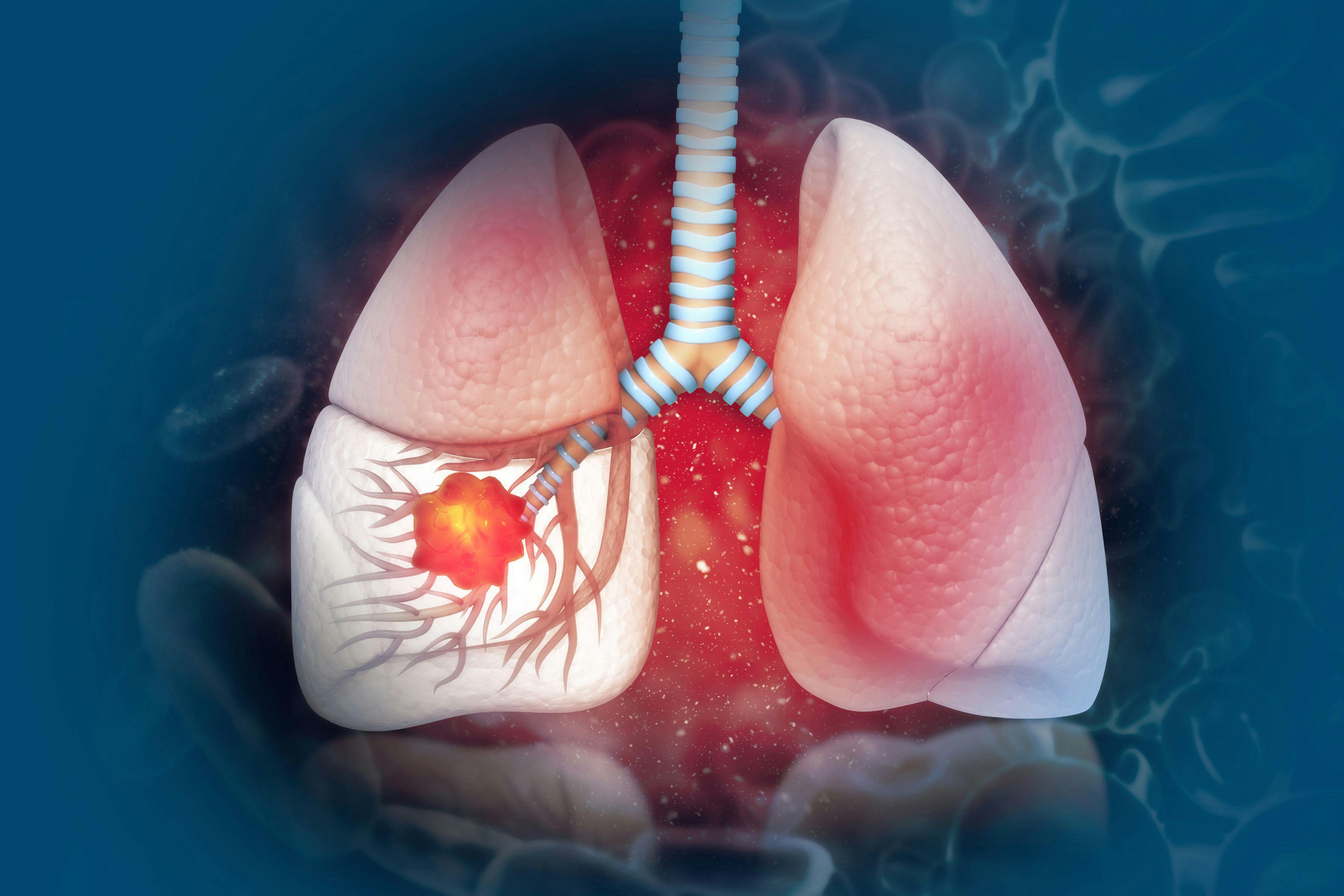 Lung cancer. lung disease | Image Credit: © Crystal light - www.stock.adobe.com