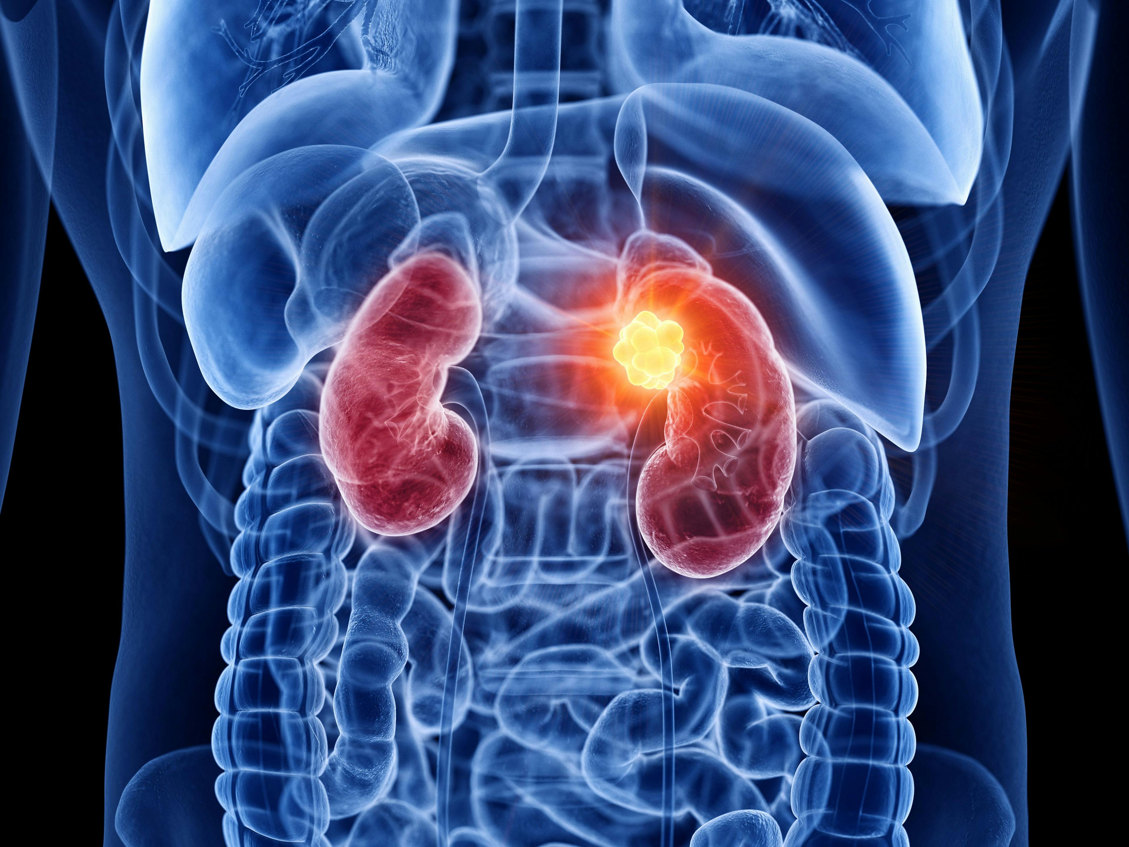3D rendering of renal cell carcinoma: ©SciePro - stock.adobe.com