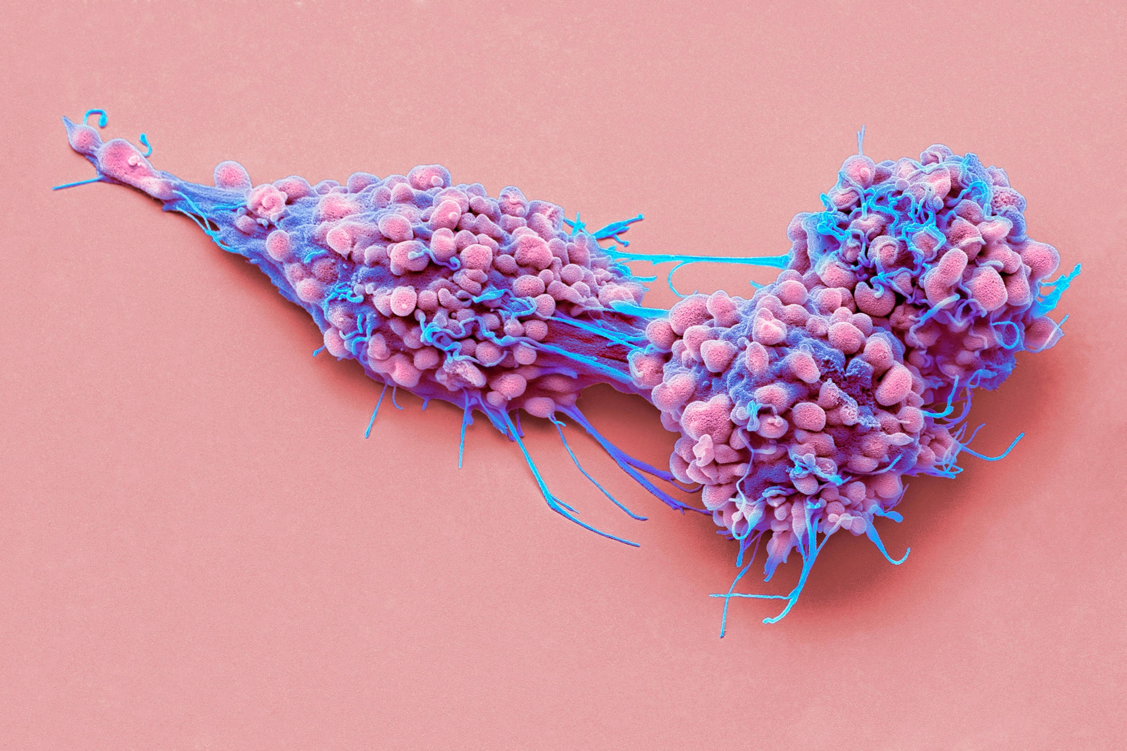 Close-up of ovarian cancer cells: ©Science RF - stock.adobe.com
