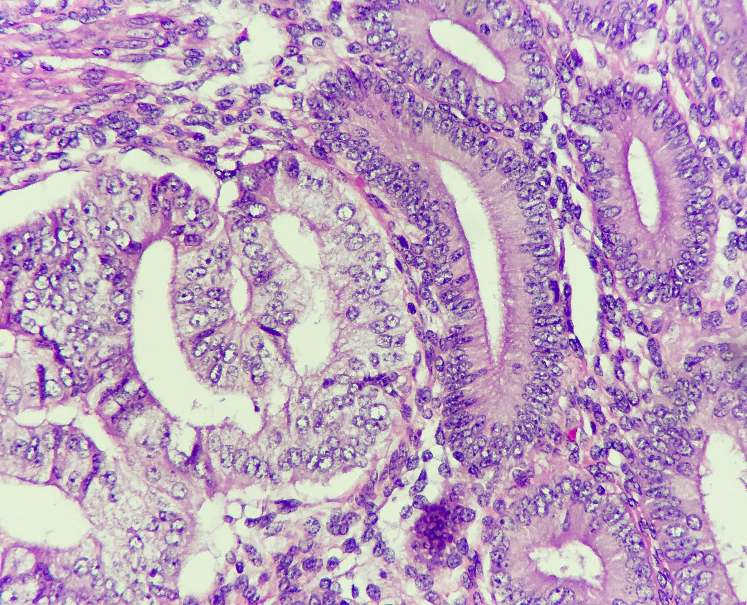 Photo of endometrial cancer on the left and normal endometrial gland on the right, magnification 400x | Image Credit: © Chutima - [stock.adobe.com]