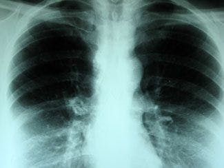 A preliminary analysis has shown that eribulin mesylate (Haloven) failed to meet its primary endpoint of improving overall survival in pre-treated patients with advanced NSCLC.