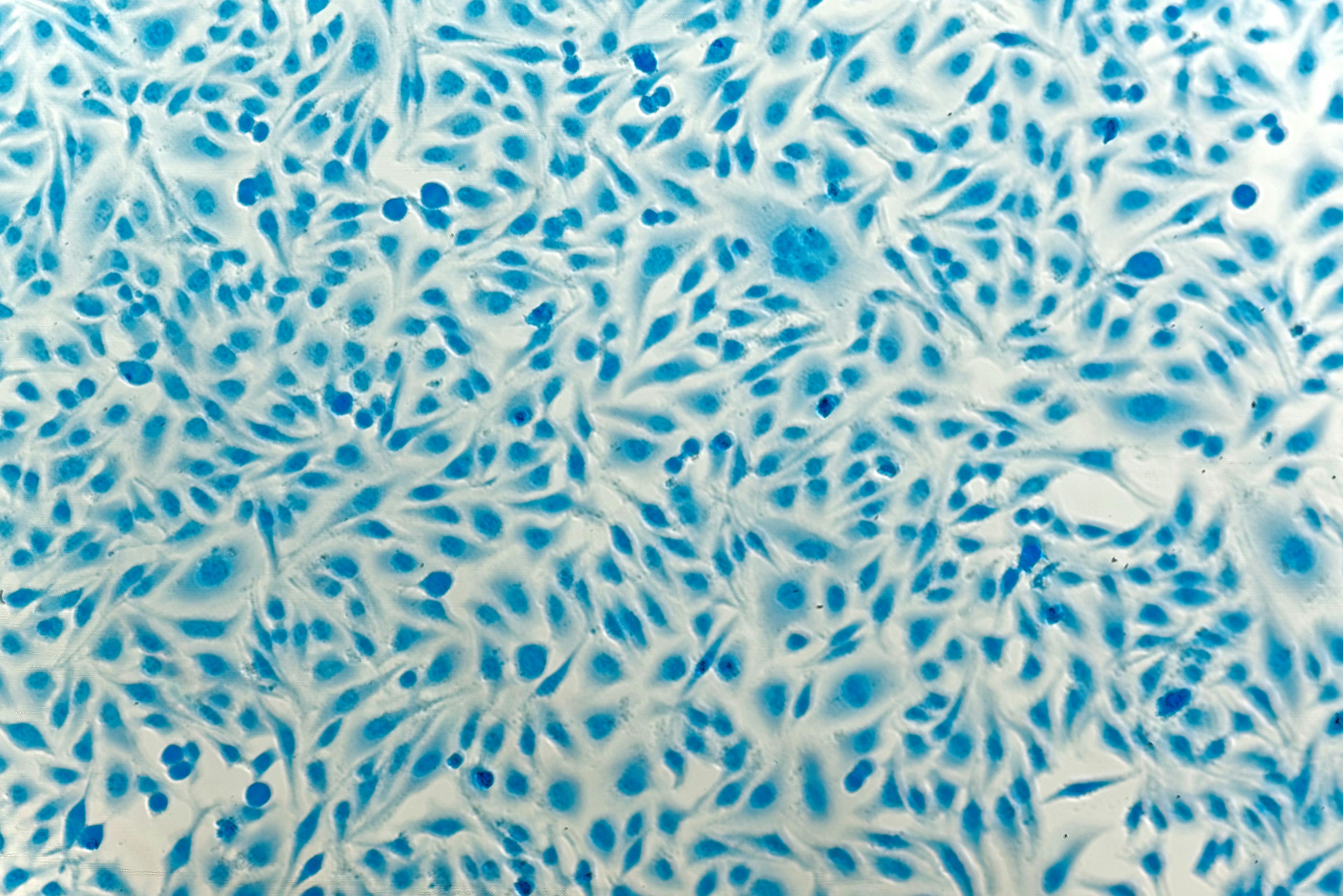 Image of cervical cancer cells: ©heitipaves - stock.adobe.com