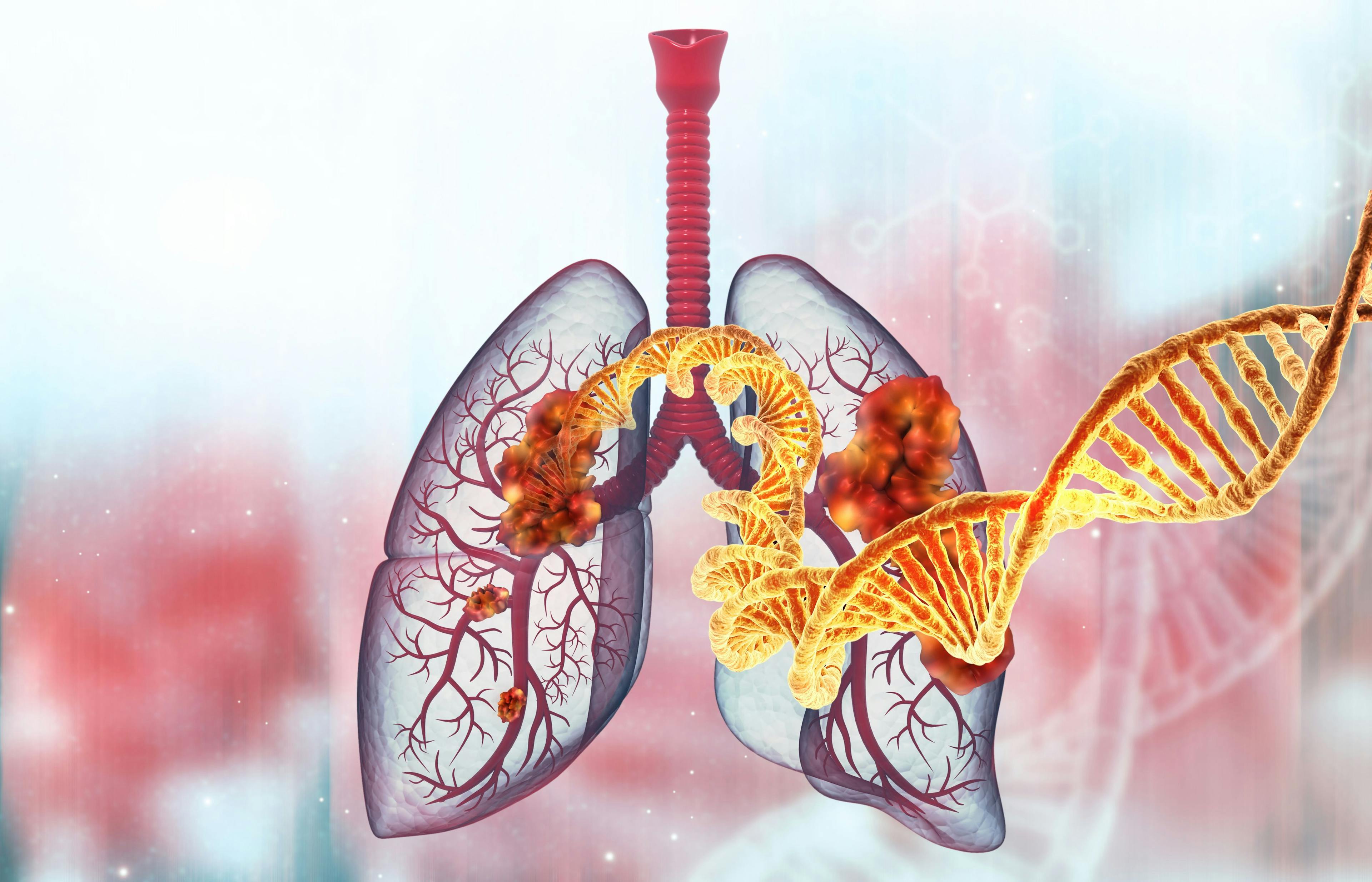 Human lung cancer with dna strand. 3d illustration | Image Credit: © Rasi - www.stock.adobe.com