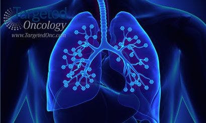Atezolizumab Proves Effective in PD-L1-Positive NSCLC
