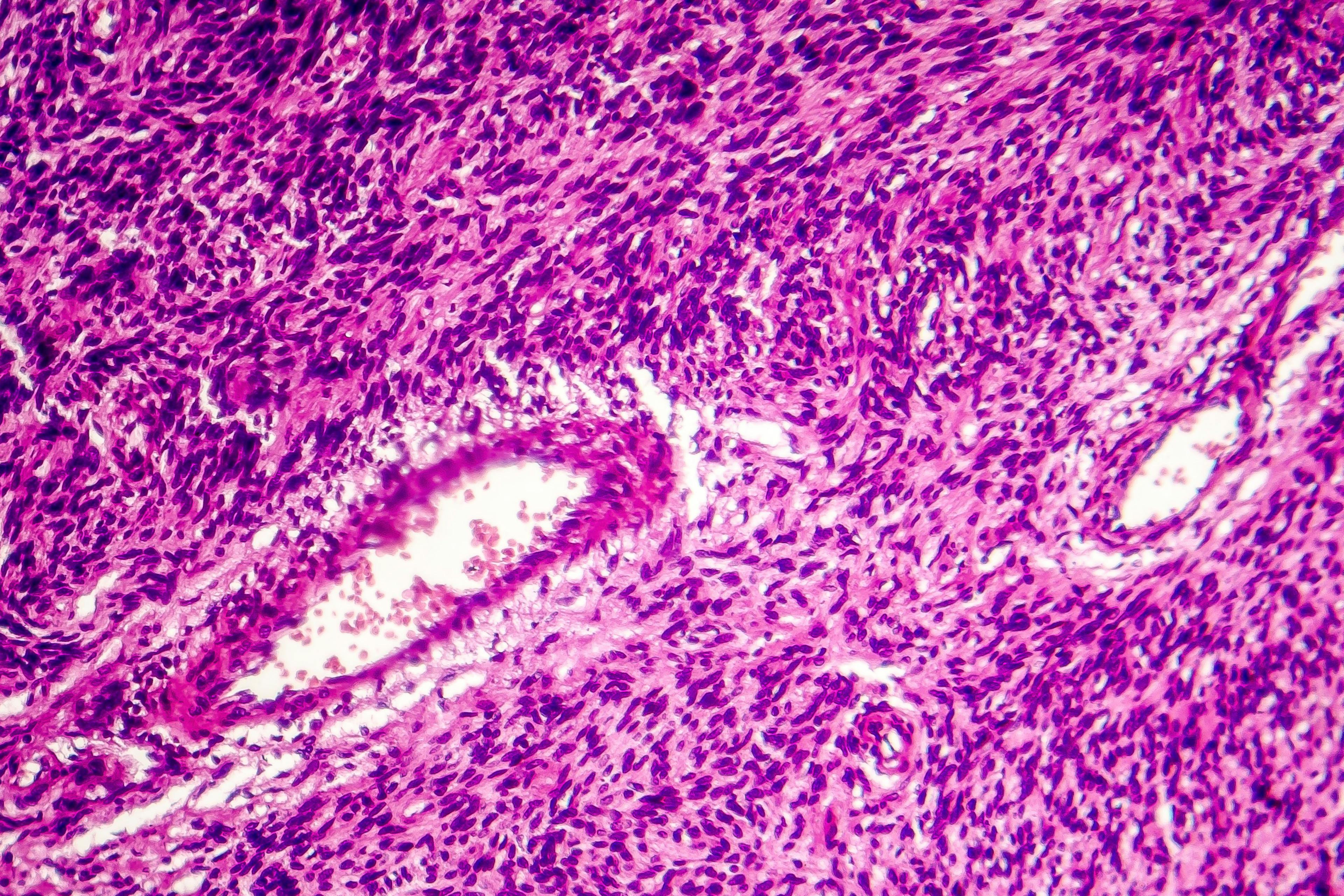 Fibrosarcoma, malignant tumor of fibroblasts, one of soft tissue sarcomas, light micrograph, photo under microscope - Image Credit: © Dr_Microbe|  [stock.adobe.com]