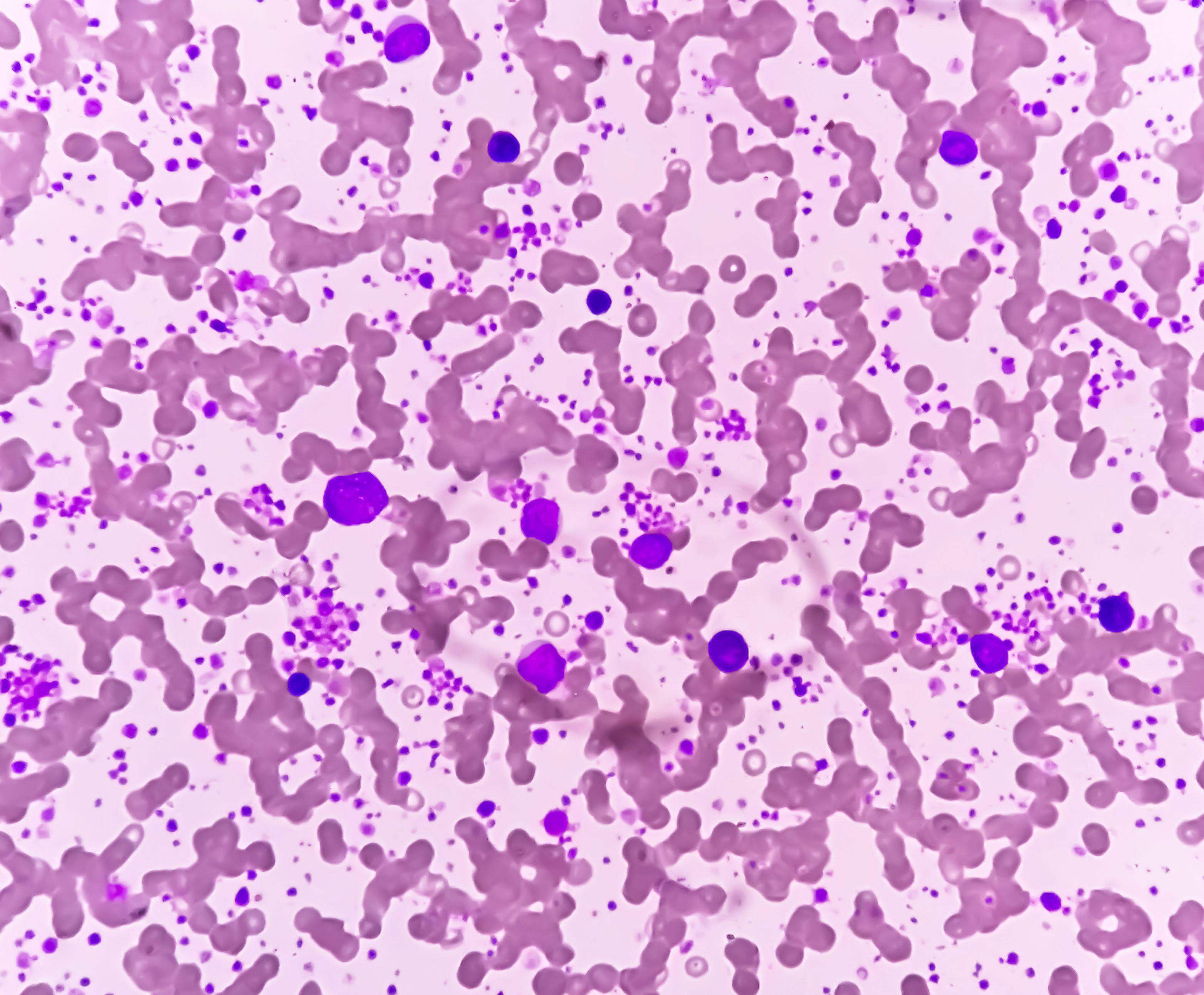 Chronic myeloid leukemia (CML) in accelerated phase with thrombocytosis. Chronic myelogenous leukemia. | Image Credit: Saiful52 - www.stock.adobe.com