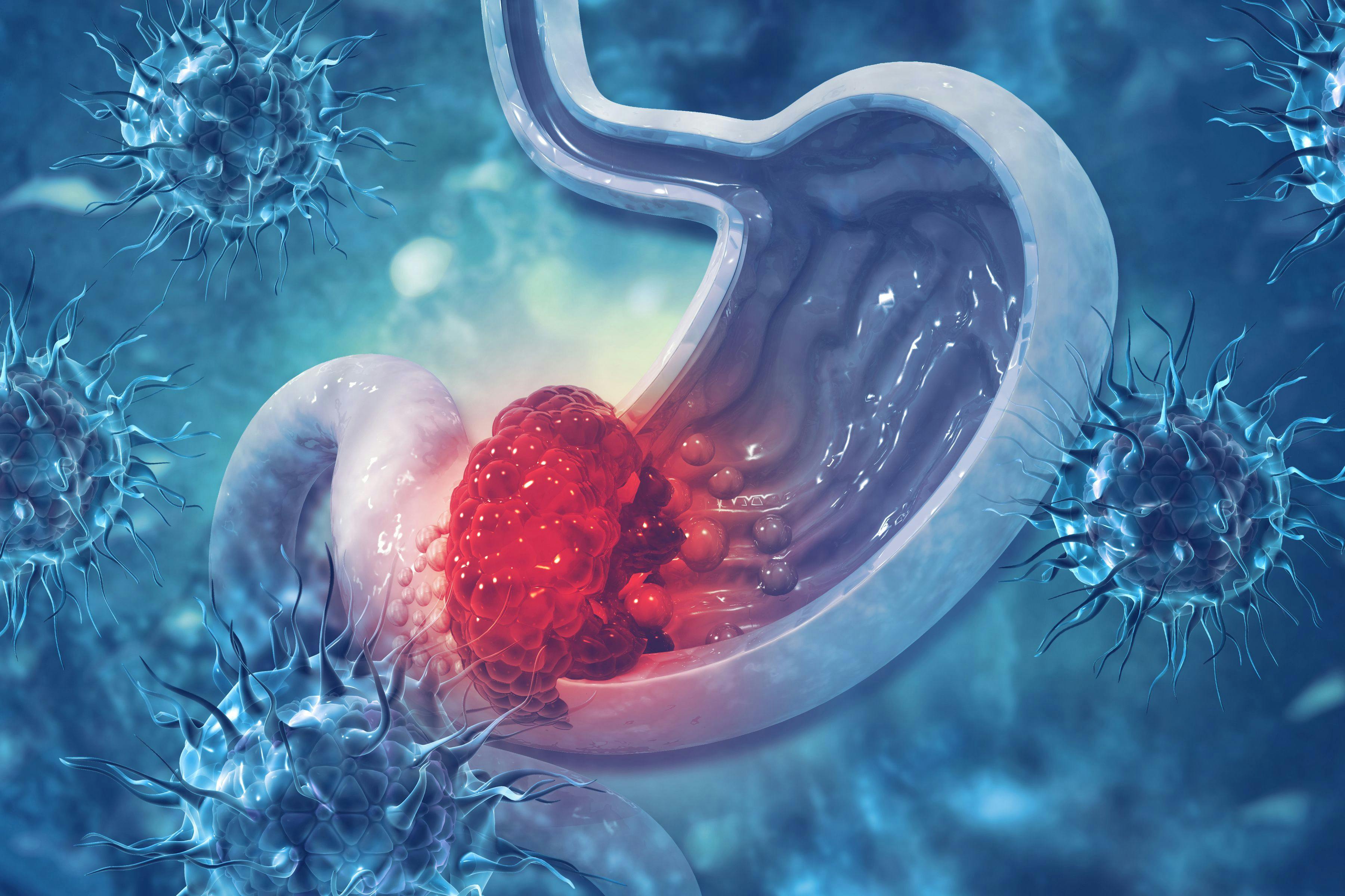 Stomach cancer. Cancer attacking cell. Stomach disease concept - Image Credit © Crystal light | stock.adobe.com