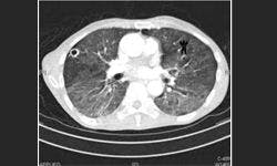 Physician Inattentional Blindness May Place Patients With Lung Cancer at Risk