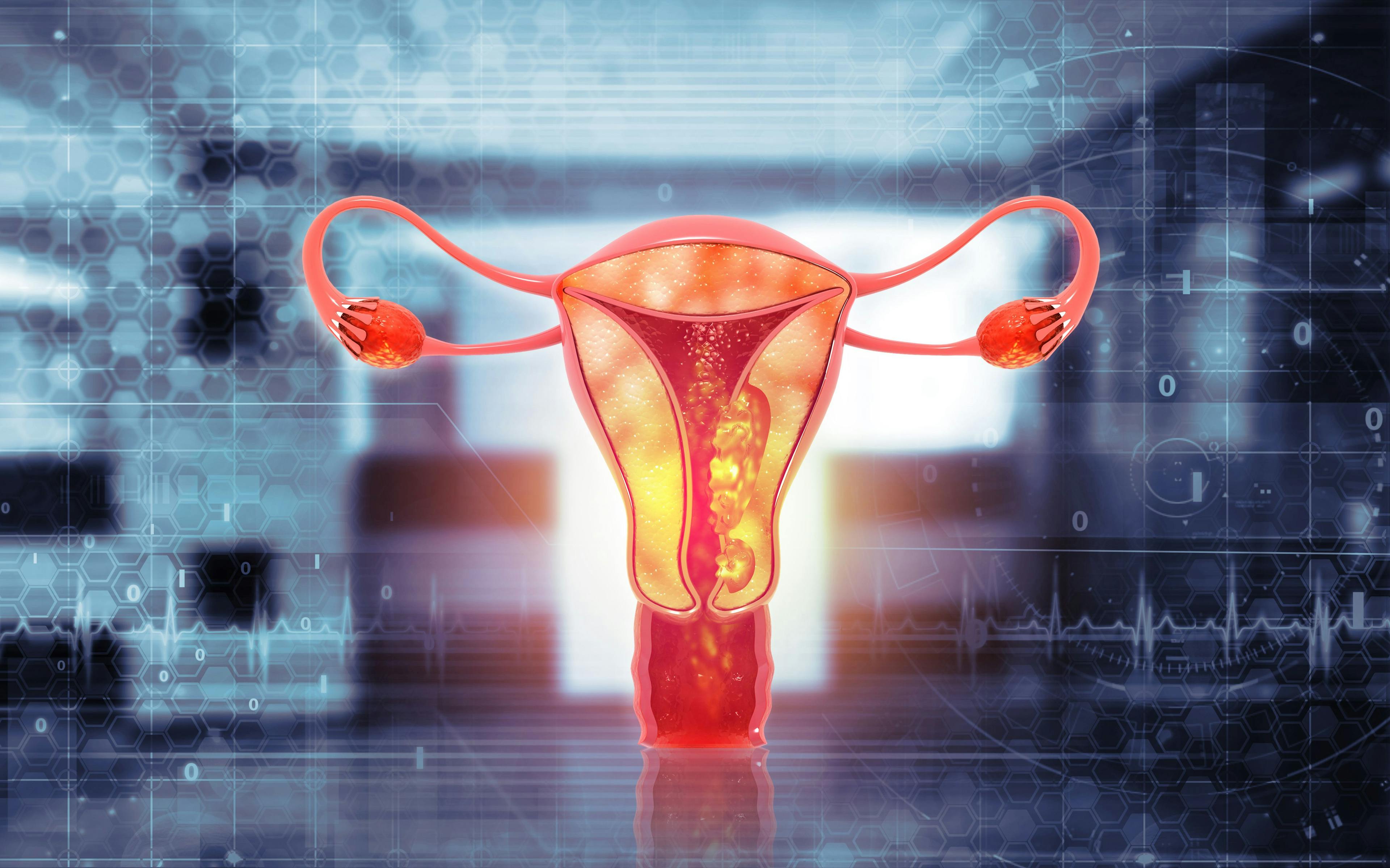 Female reproductive system diseases. Uterus cancer and endometrial malignant tumor as a uterine medical concept. 3d illustration: © Crystal Light - stock.adobe.com